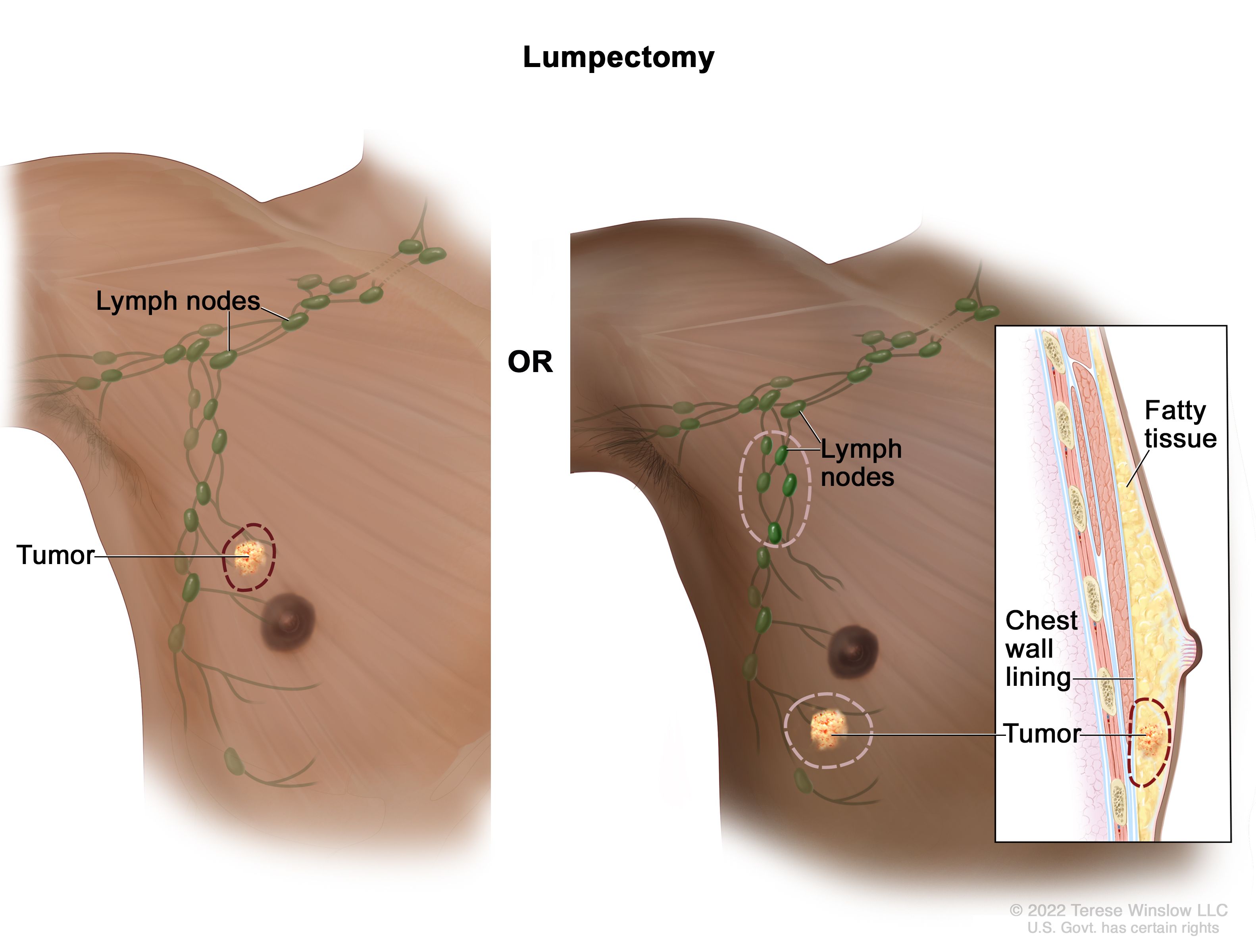 Breast Lymph Nodes Swelling