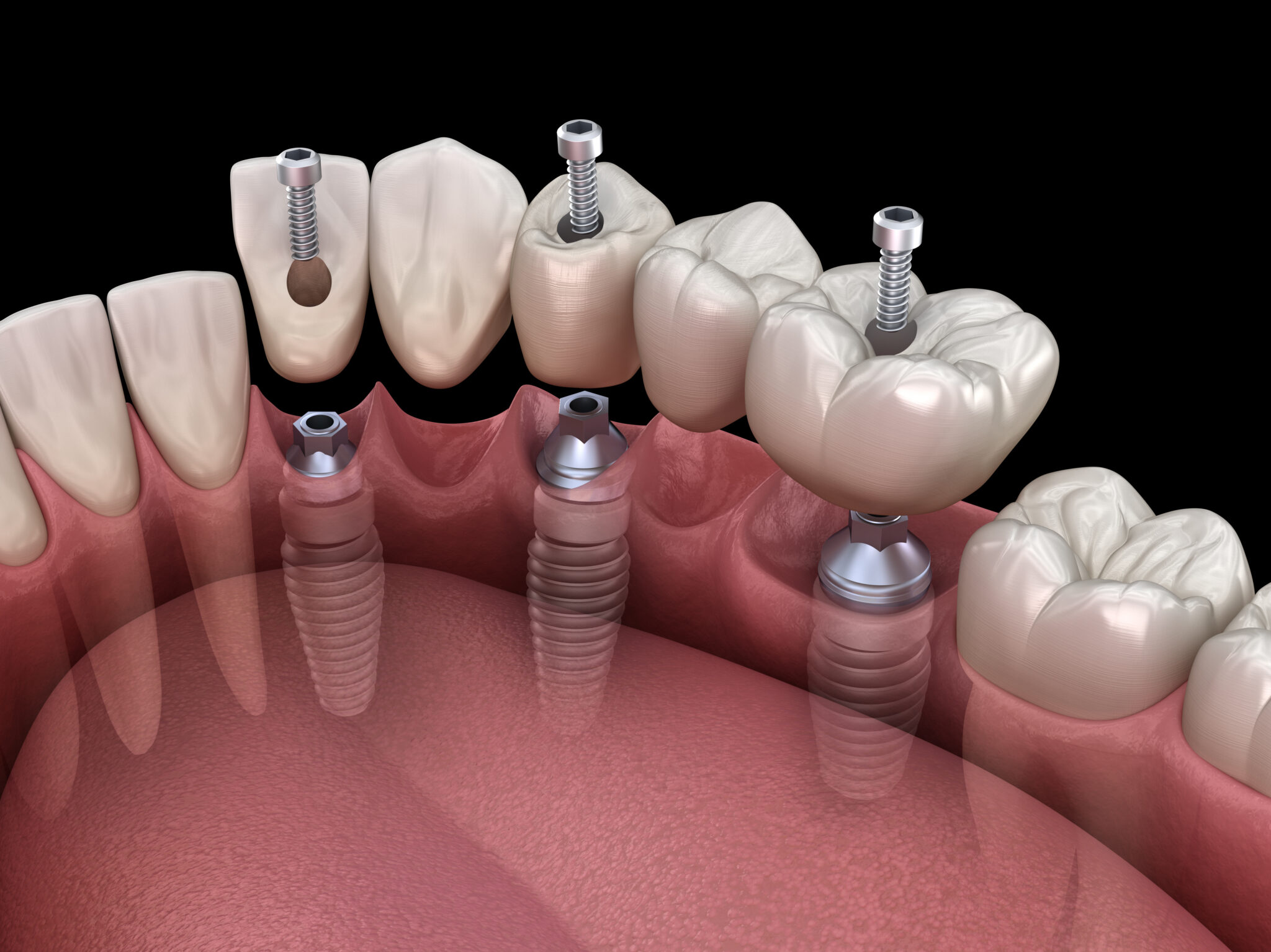 Bridge Implants Teeth