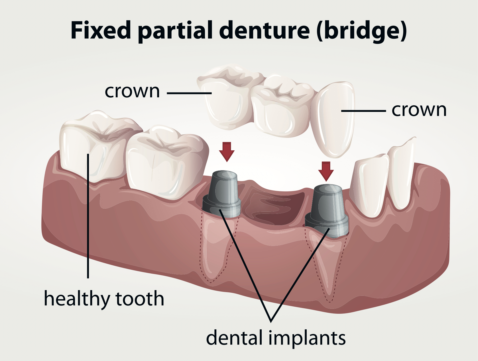 Bridge Work For Missing Teeth