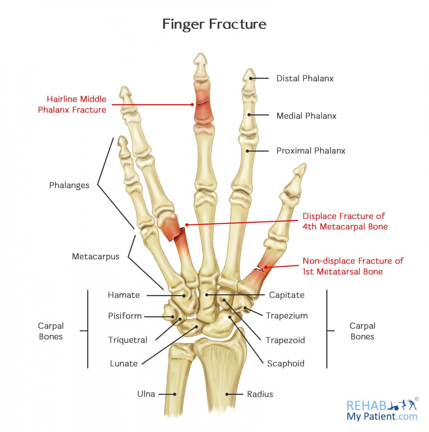 Broken Finger Recovery Time