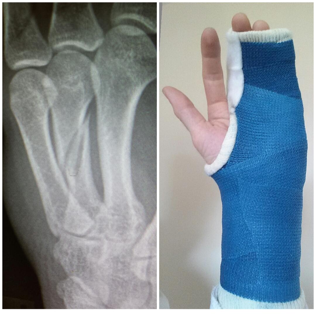 Broken Hand Cast