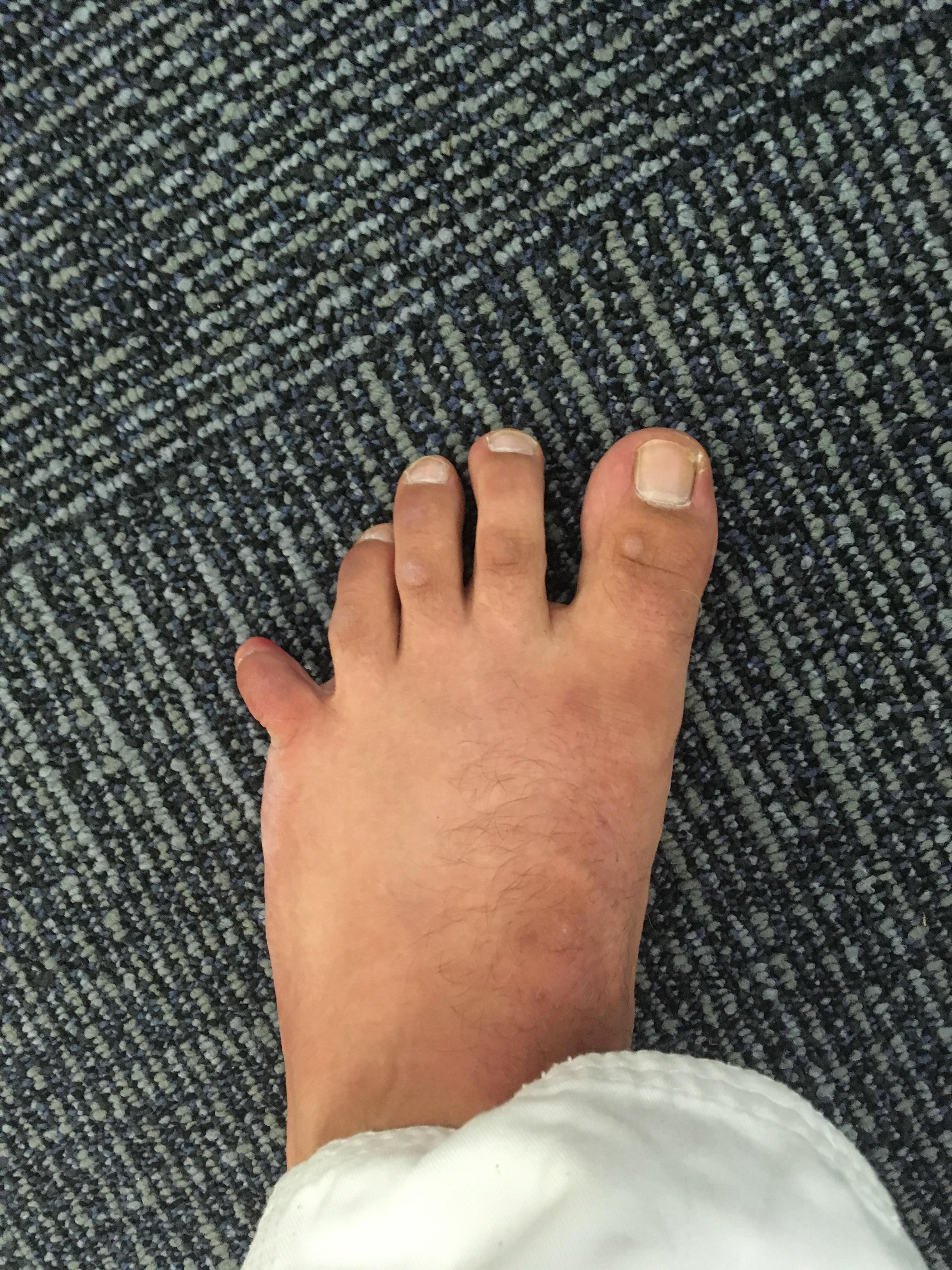 Broken Pinky Toe