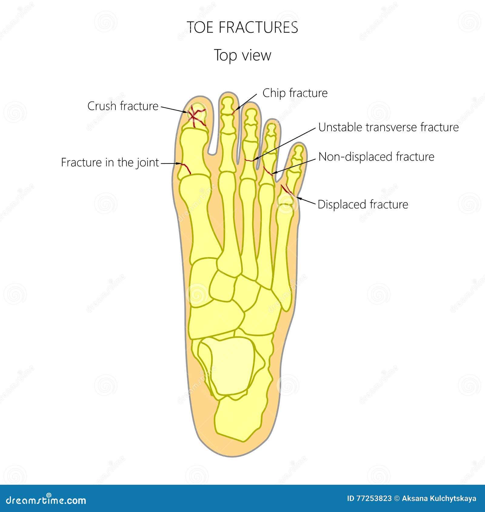 Broken Toe Symptoms
