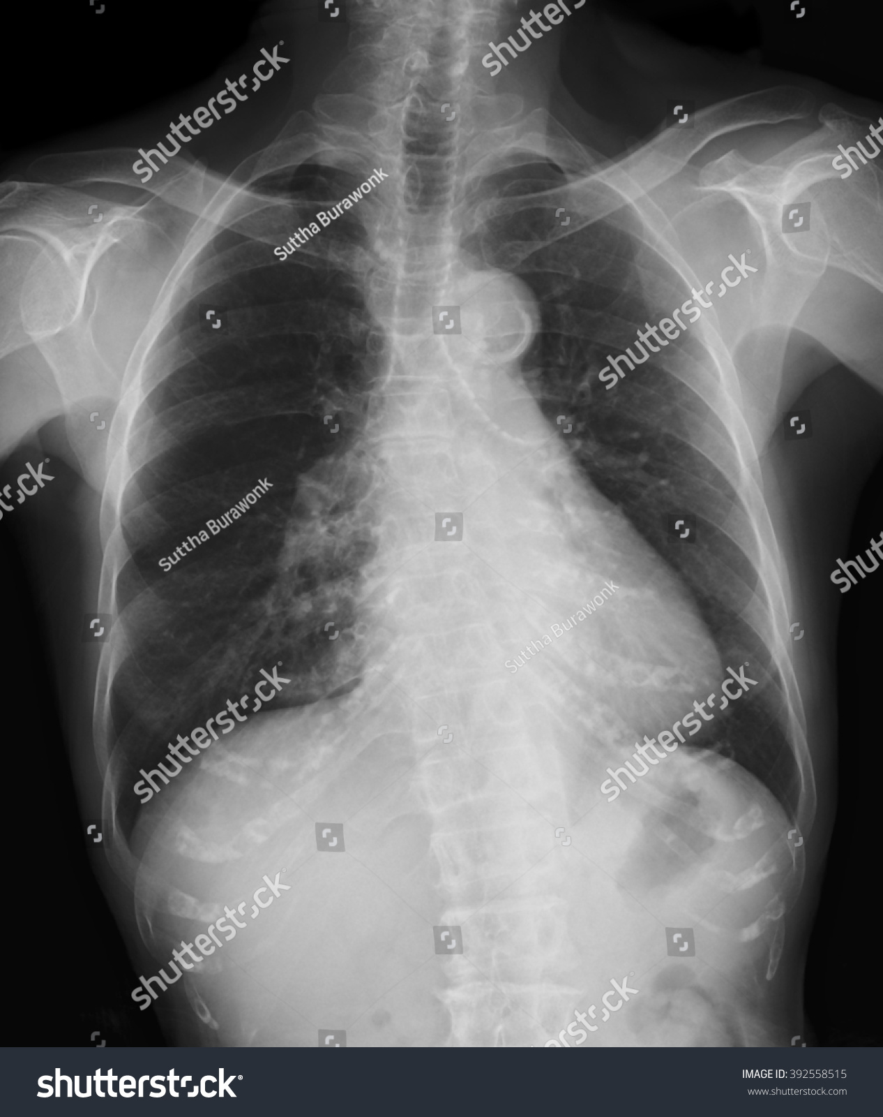 Bronchitis X Ray