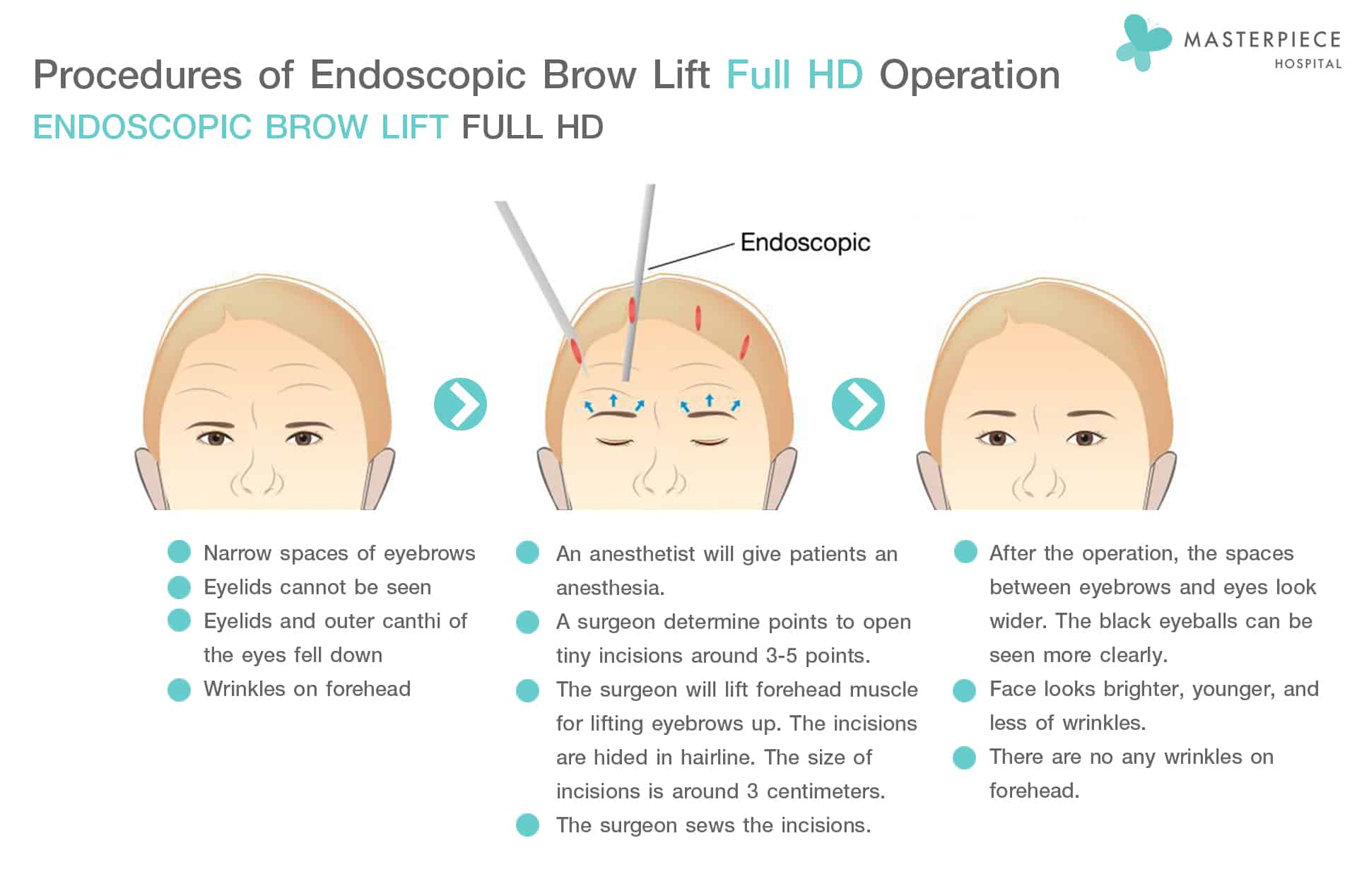 Brow Lift Procedure
