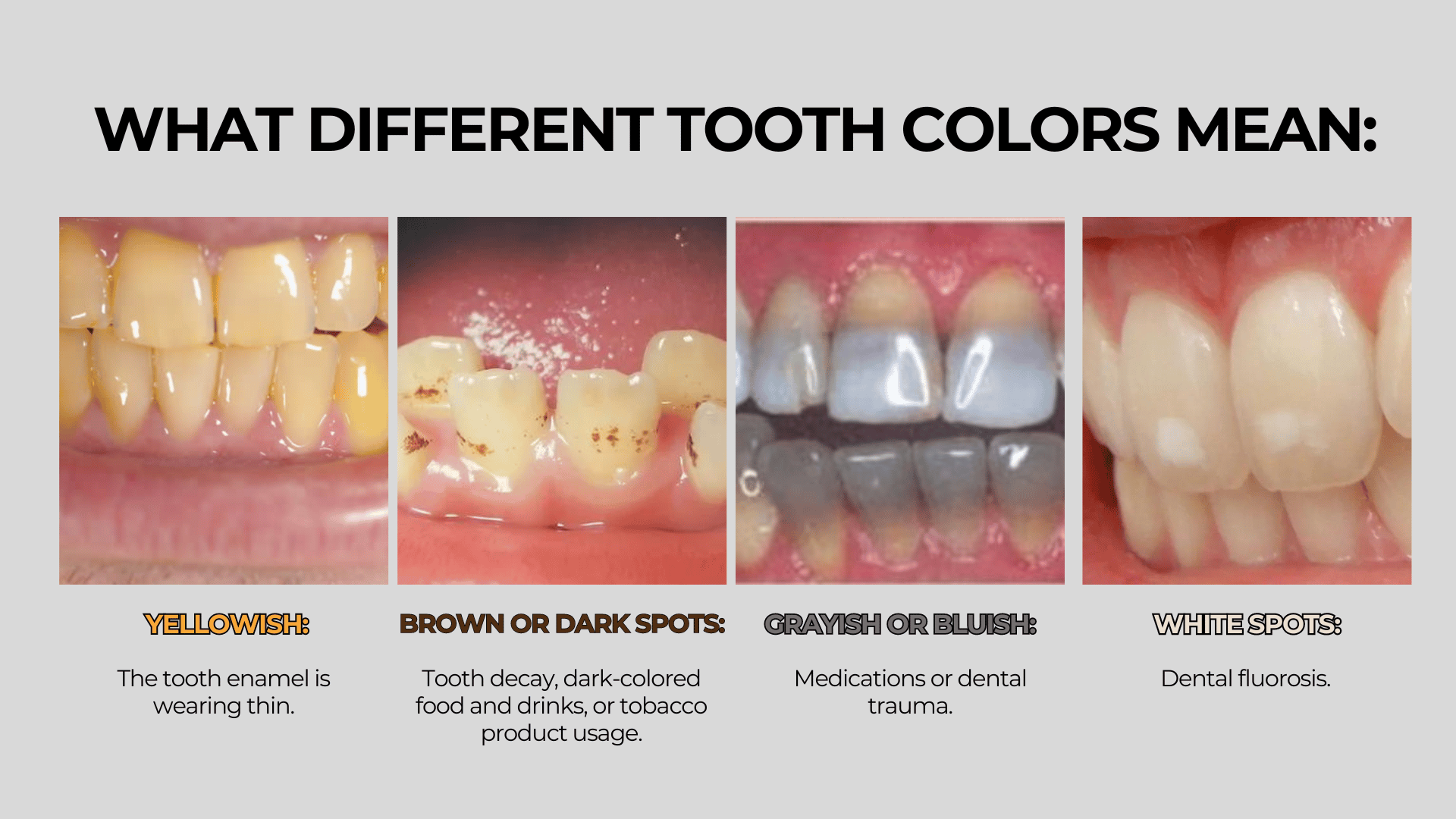 Brown Colour On Teeth