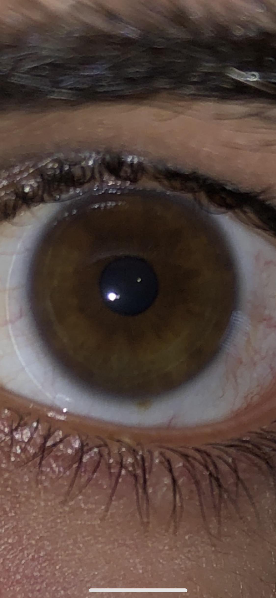Brown Spot On Eye