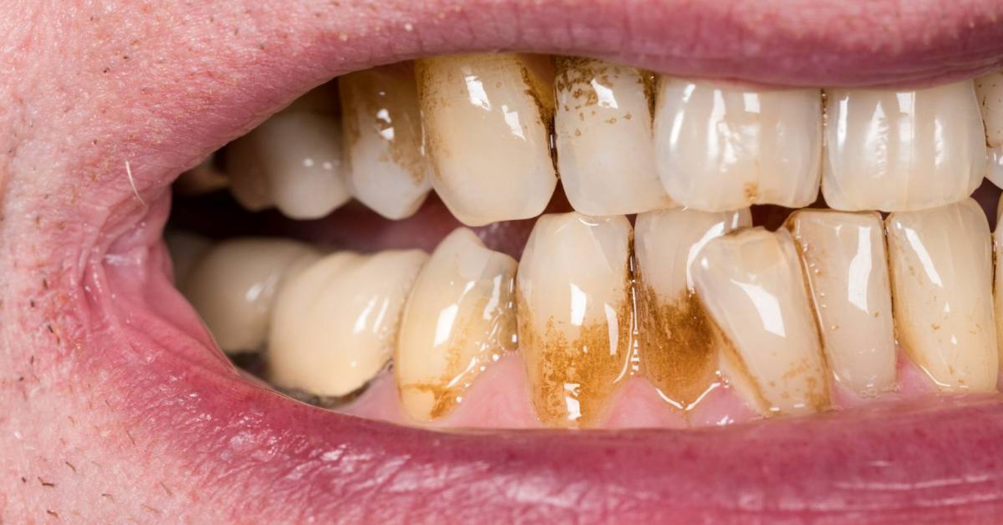 Brown Stain On Molar