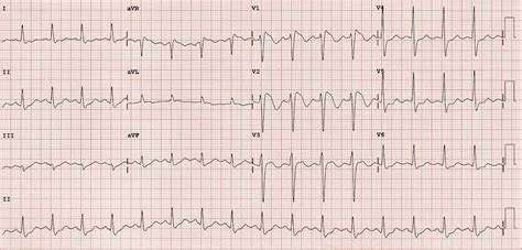Brugada Syndrome Ecg