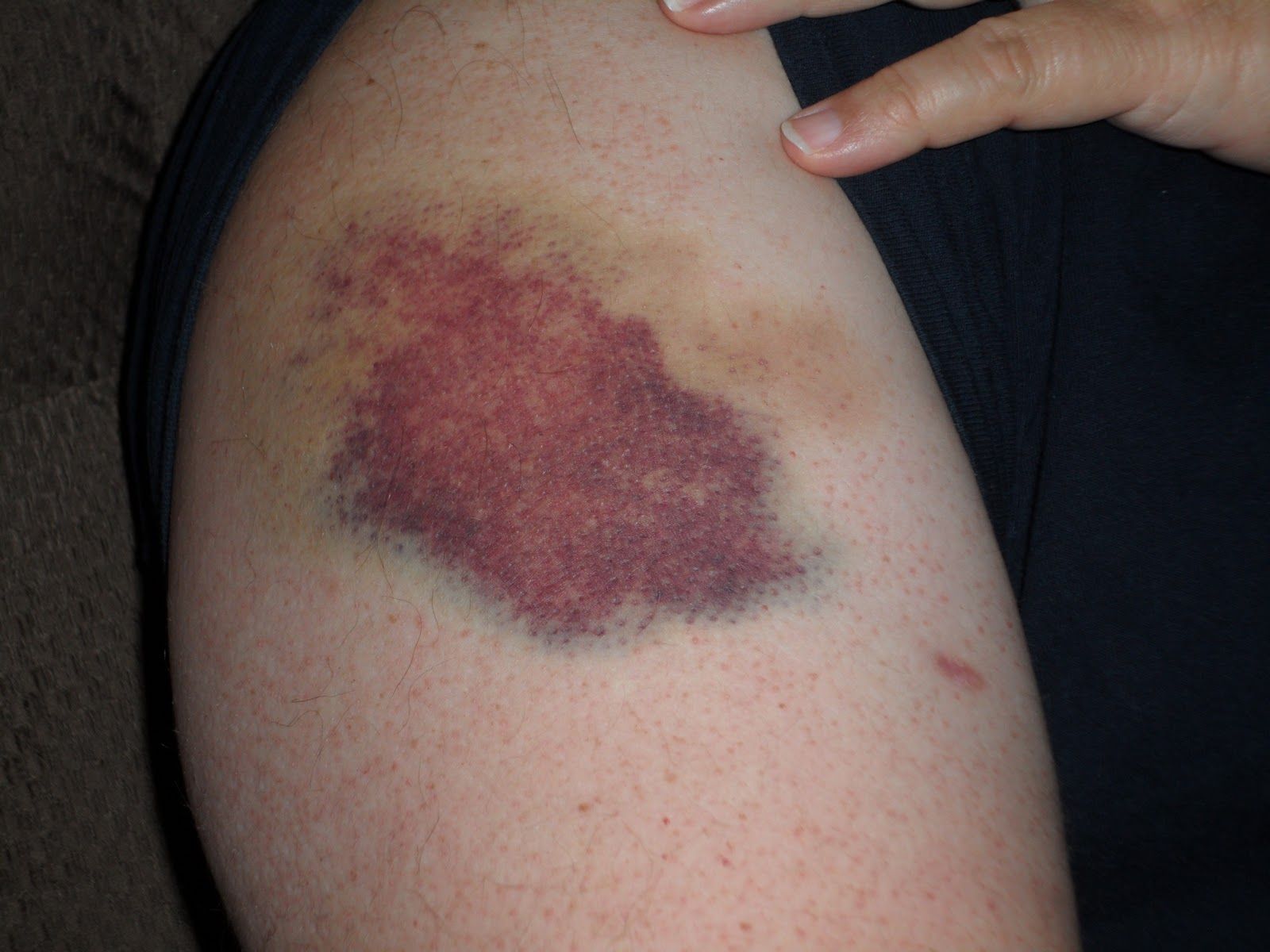 Bruise From Blood Draw