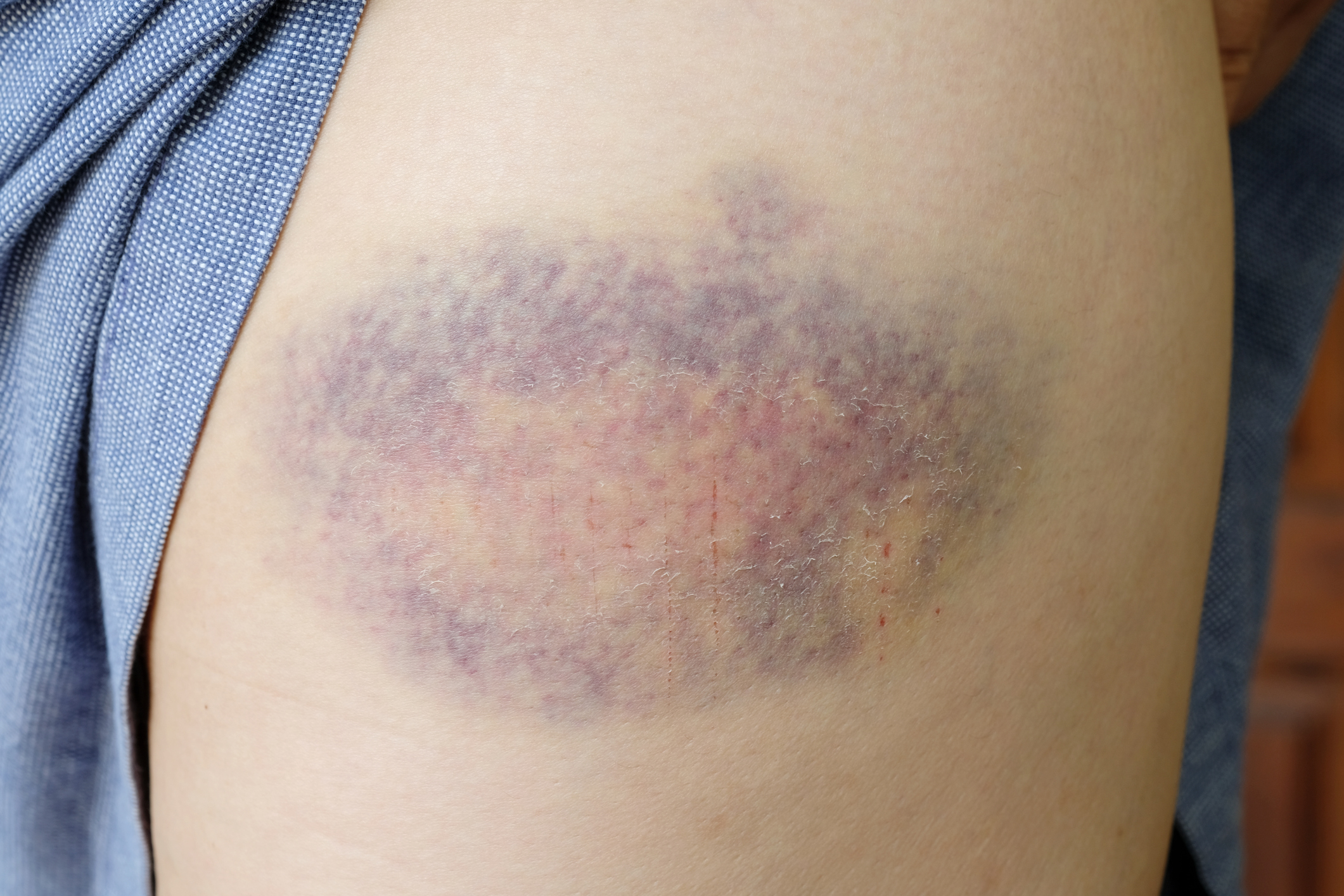 Bruise On Muscle