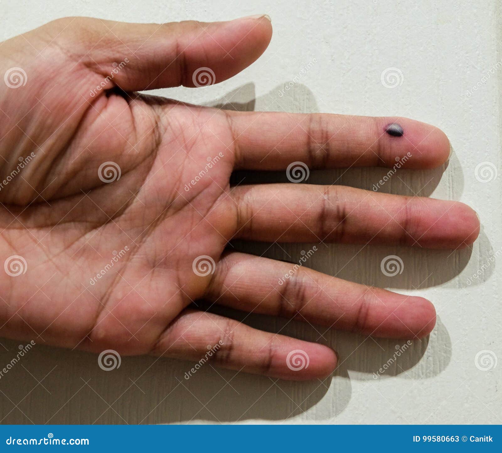 Bruising Of The Fingers