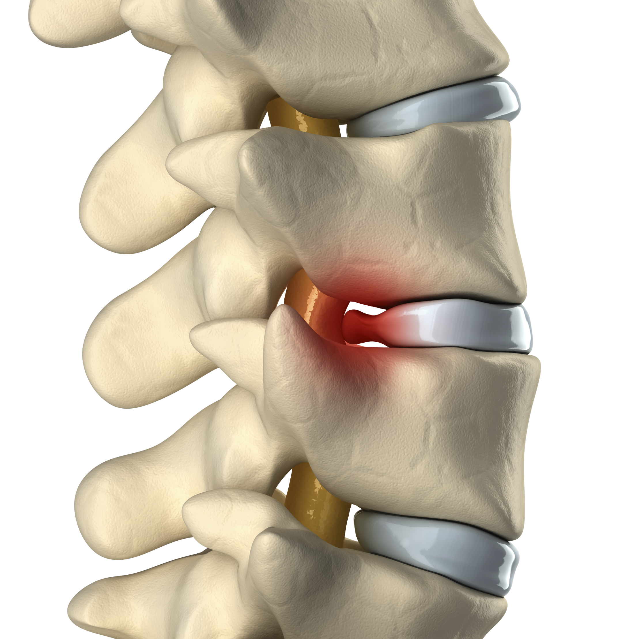 Bulging Disc Spine