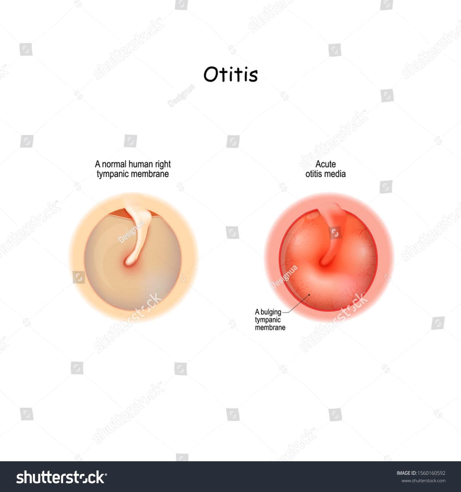 Bulging Tympanic Membrane