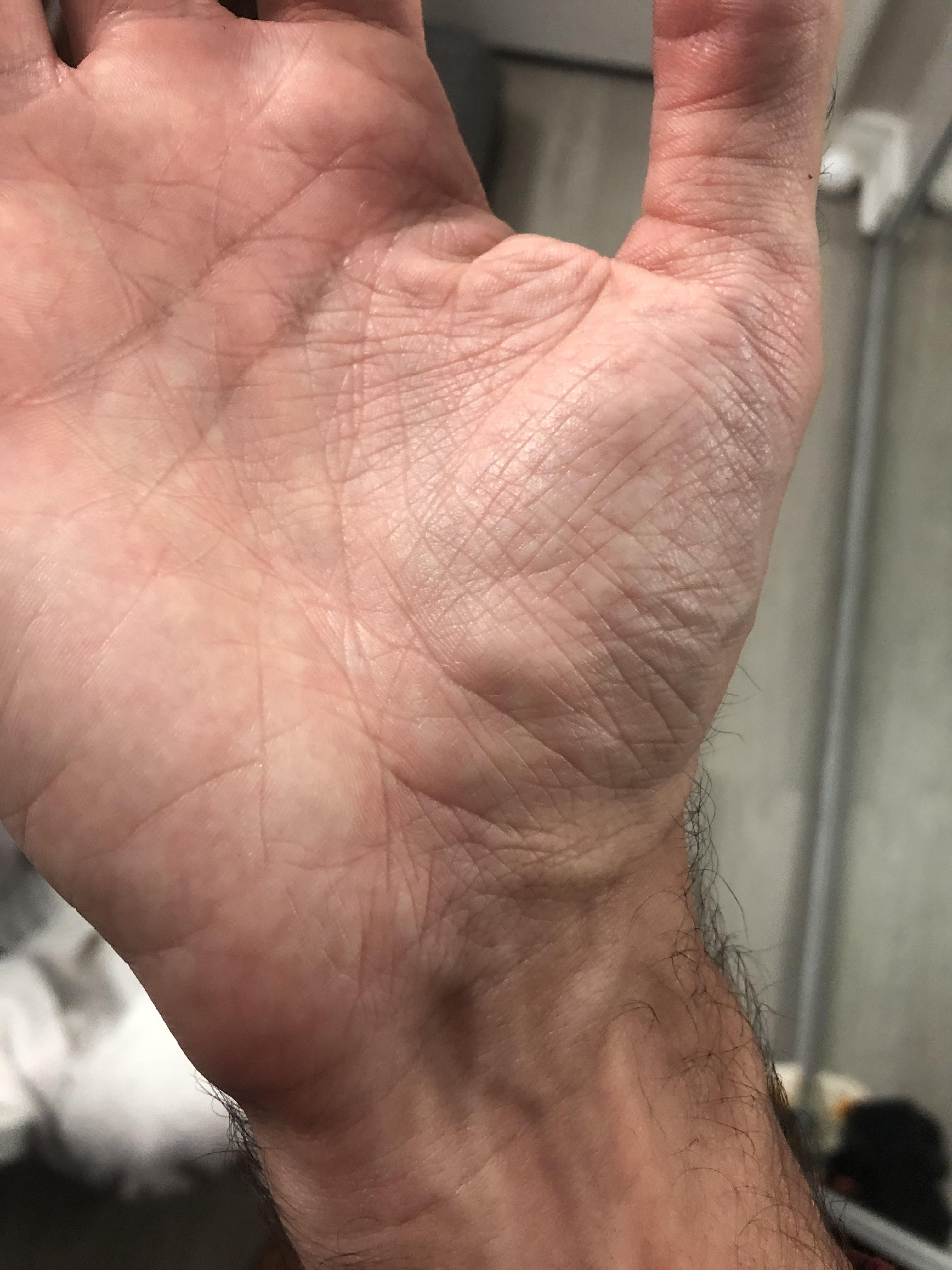 Bulging Veins In Hands