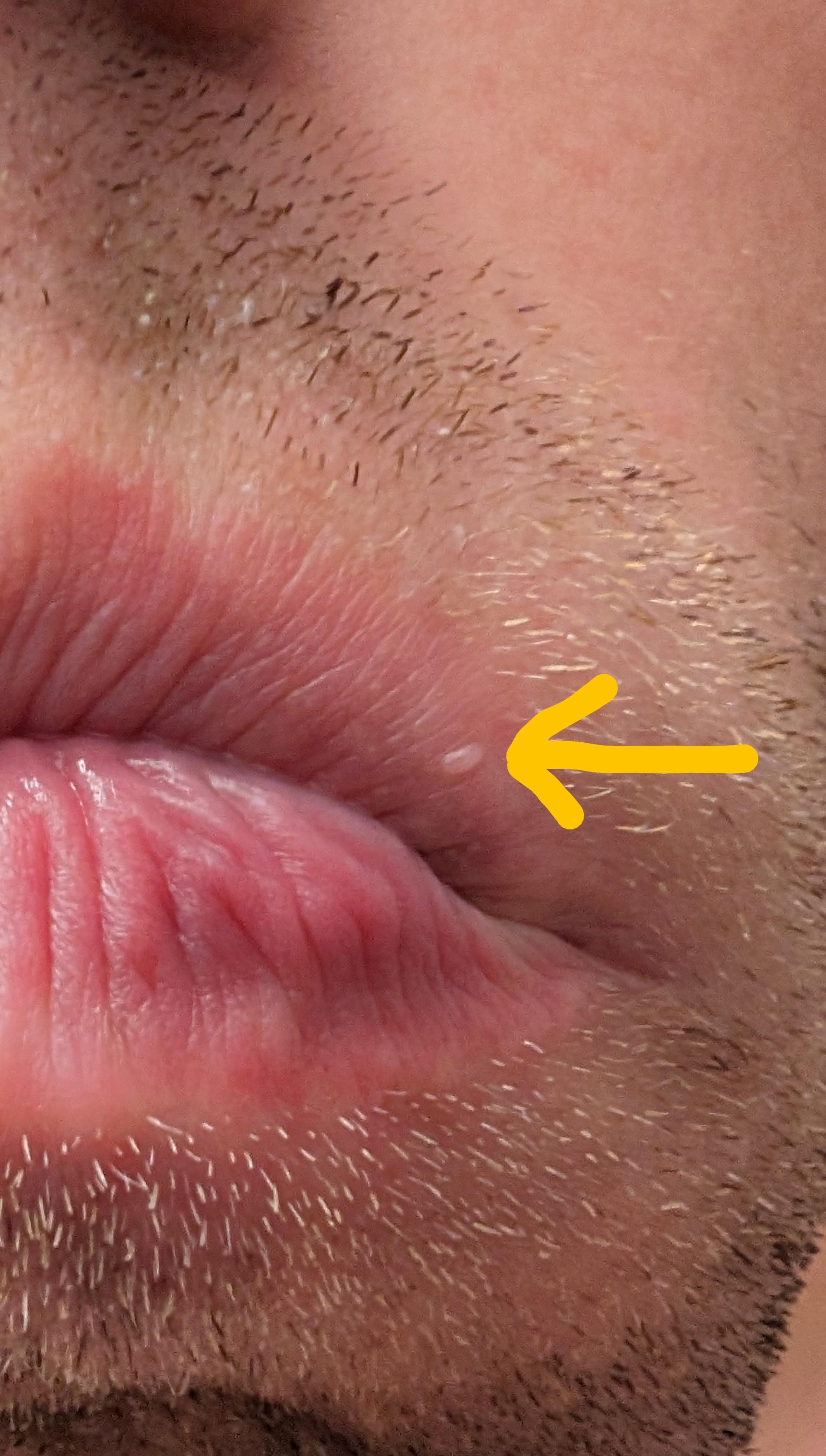 Bump In Lip No Pain