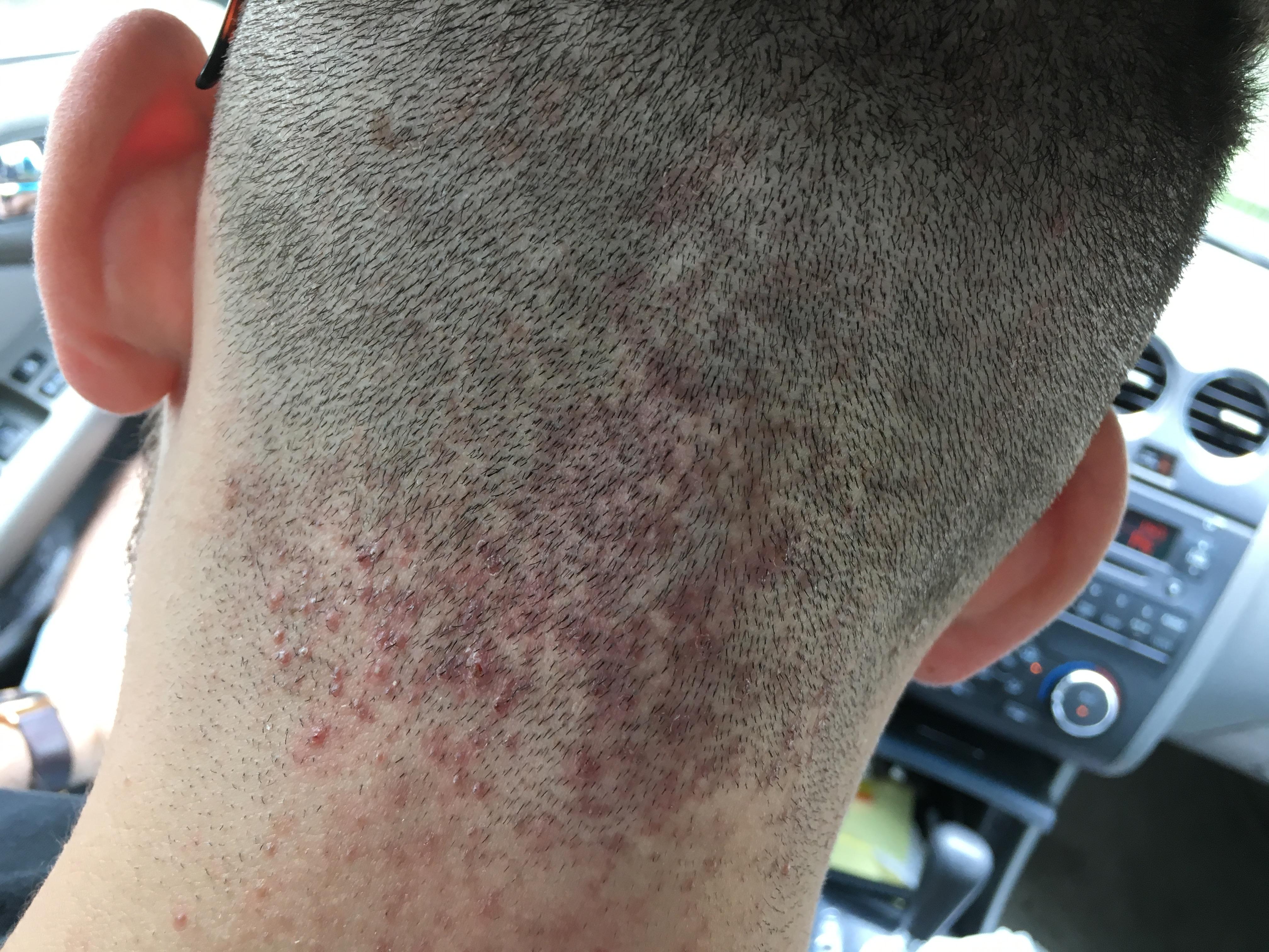Bump On Back Of Neck