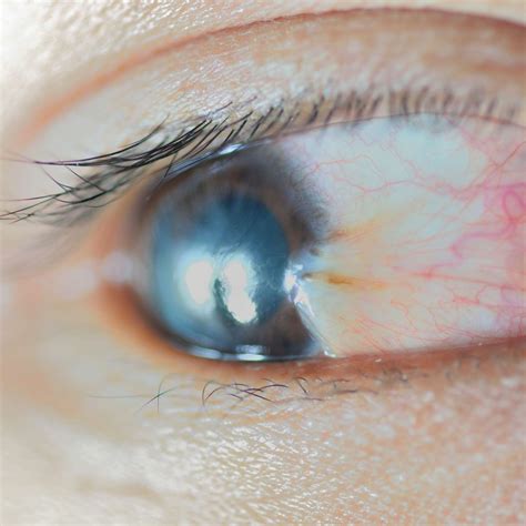 Bump On Eyeball