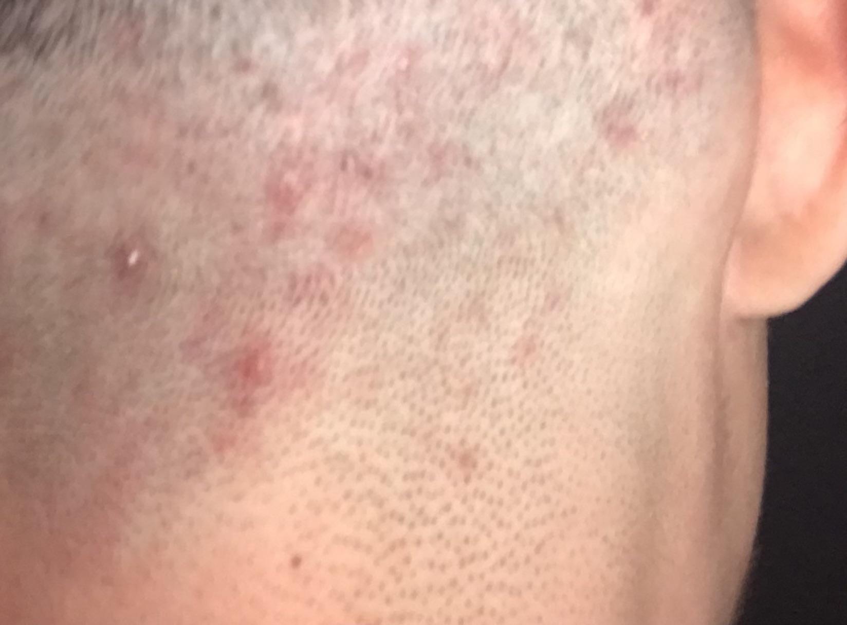 Bumps After Shaving