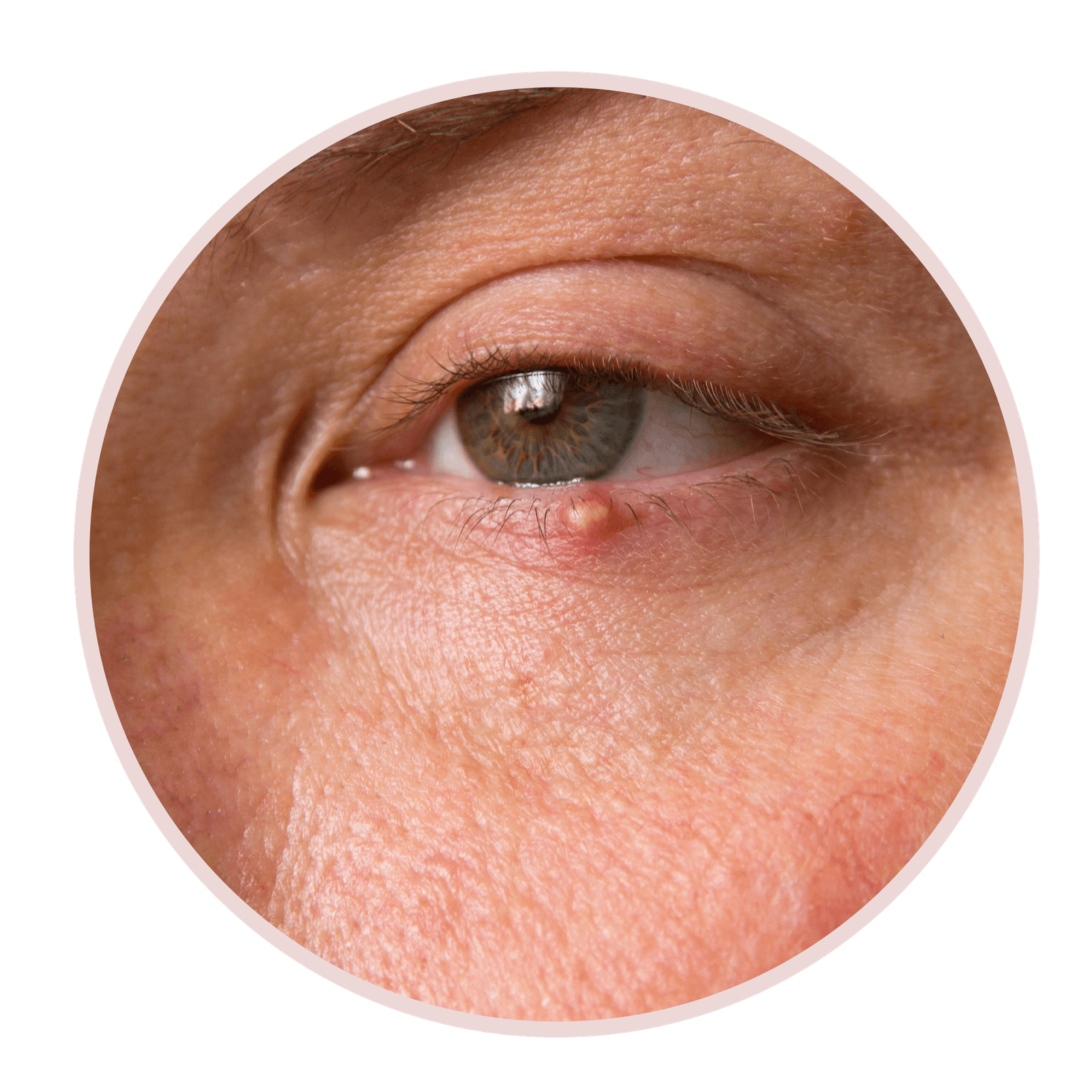 Bumps Under The Eyes Area