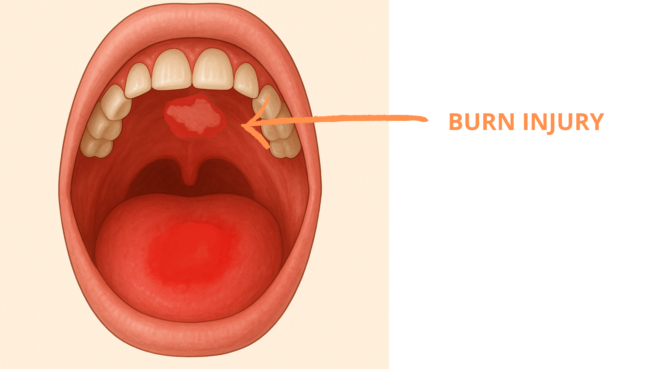Burn On Roof Of Mouth