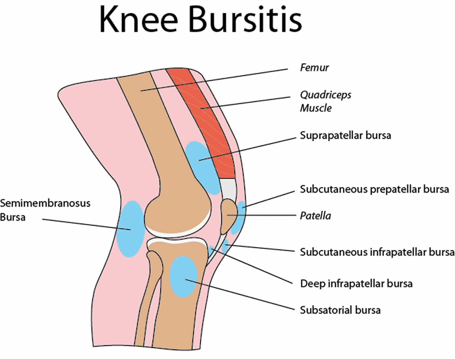 Bursa Treatment Knee