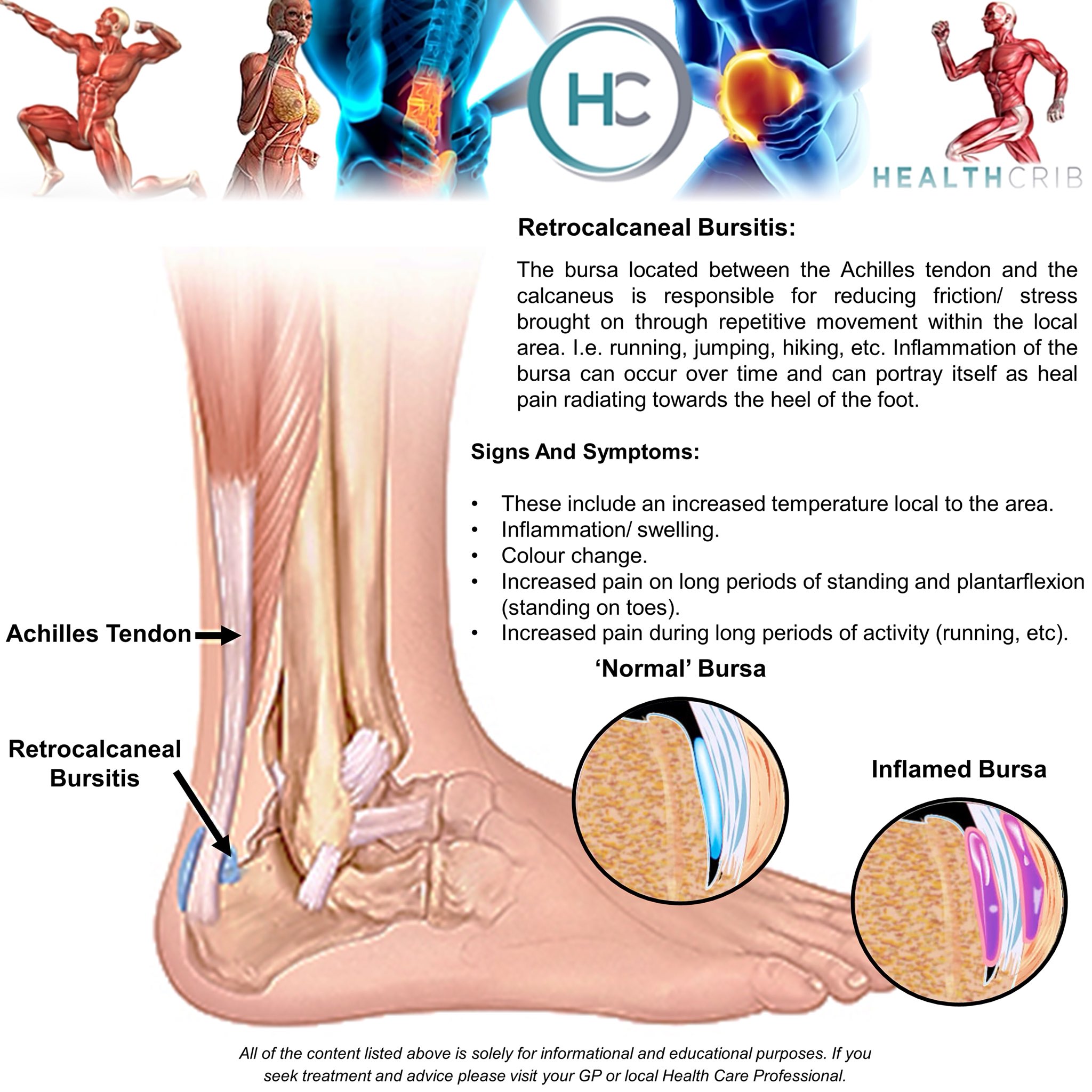 Bursitis In The Ankle