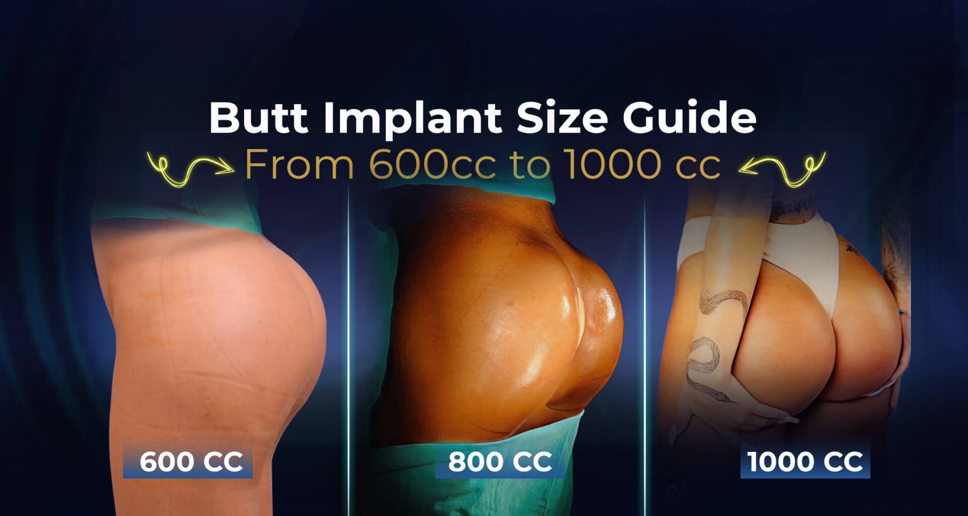 Buttock Augmentation With Implants