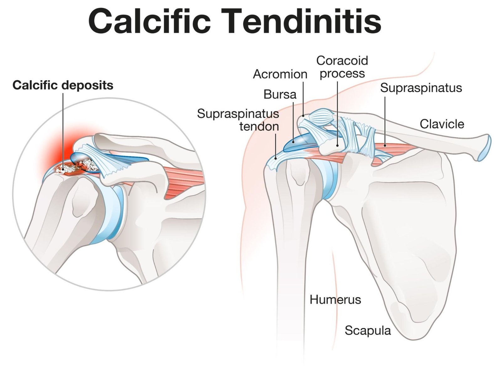 Calciferous Tendonitis Shoulder