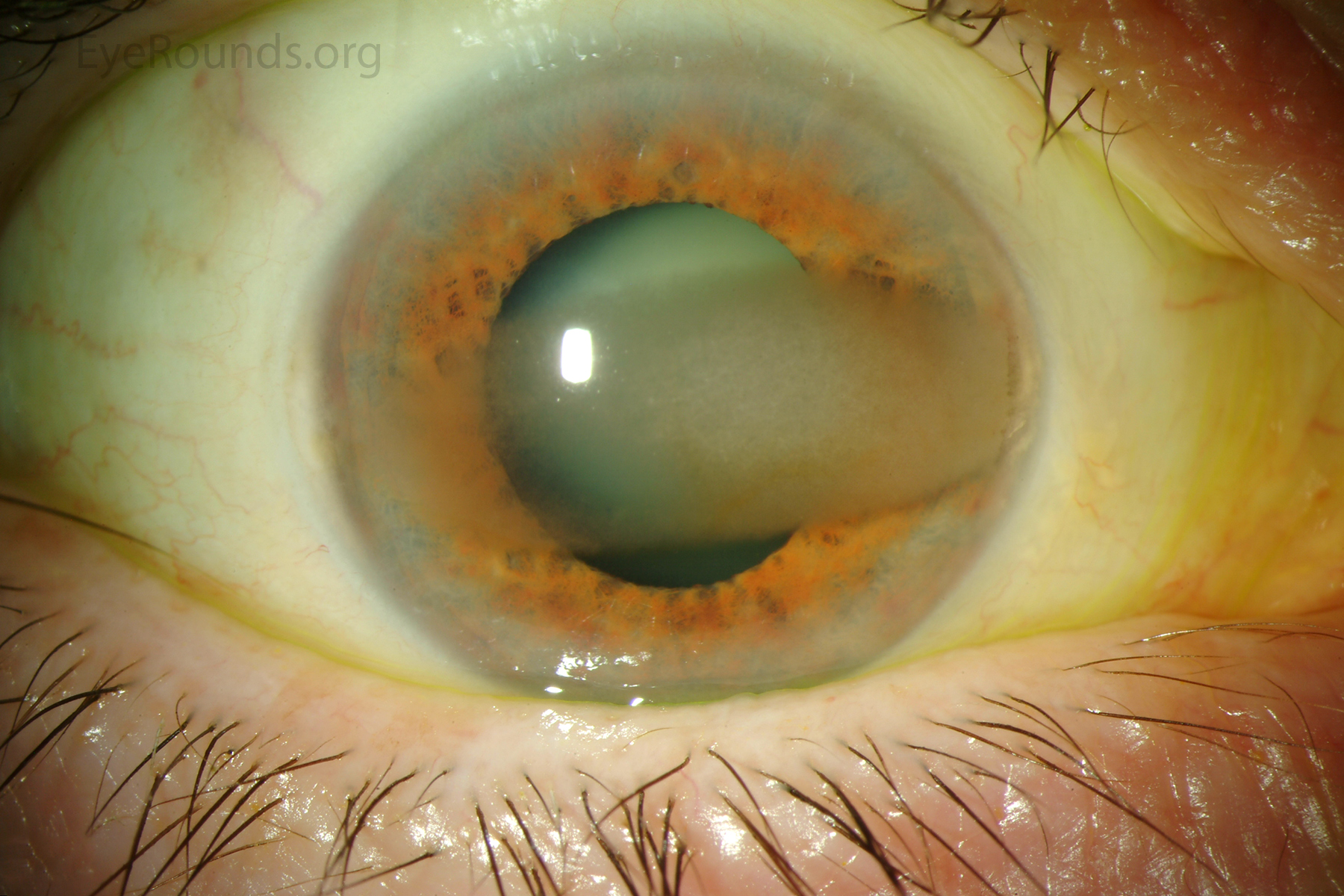 Calcium Deposits In Eye