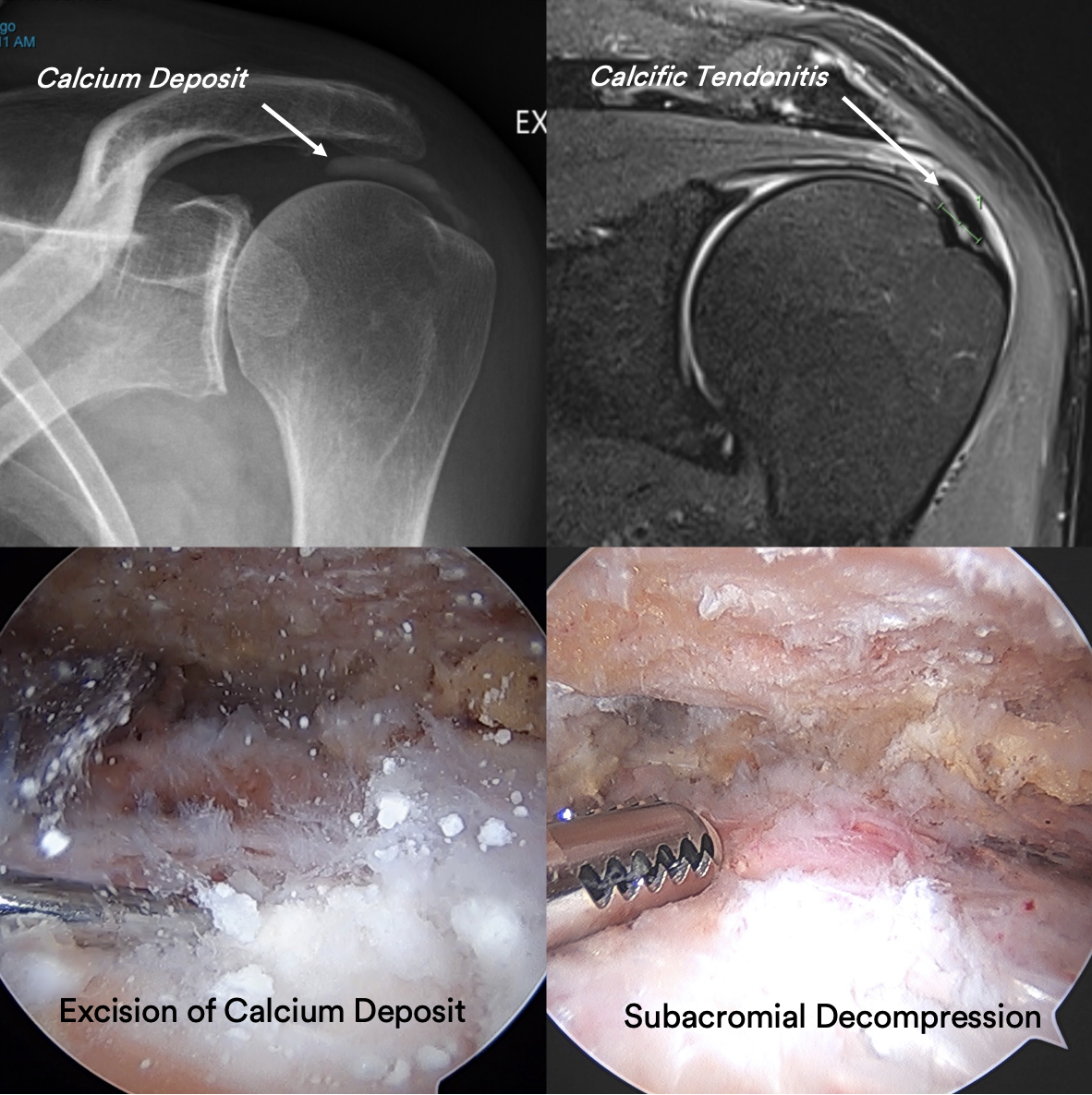 Calcium Deposits In Shoulder