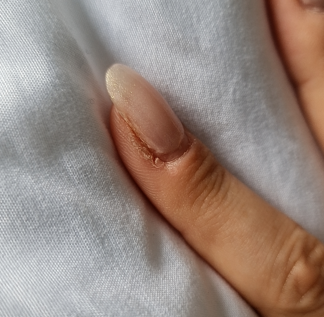 Callus On Finger