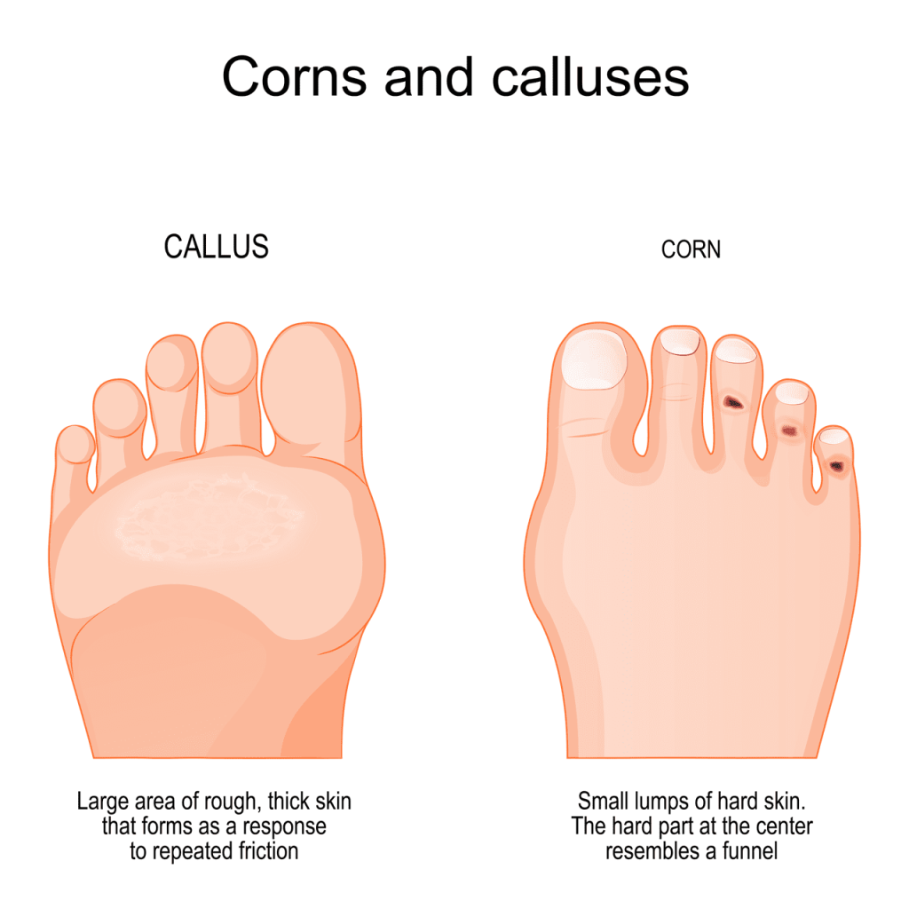 Callus Vs Corn