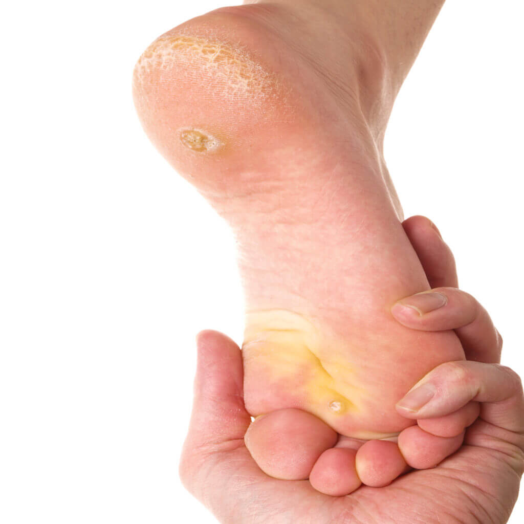 Calluses On Feet