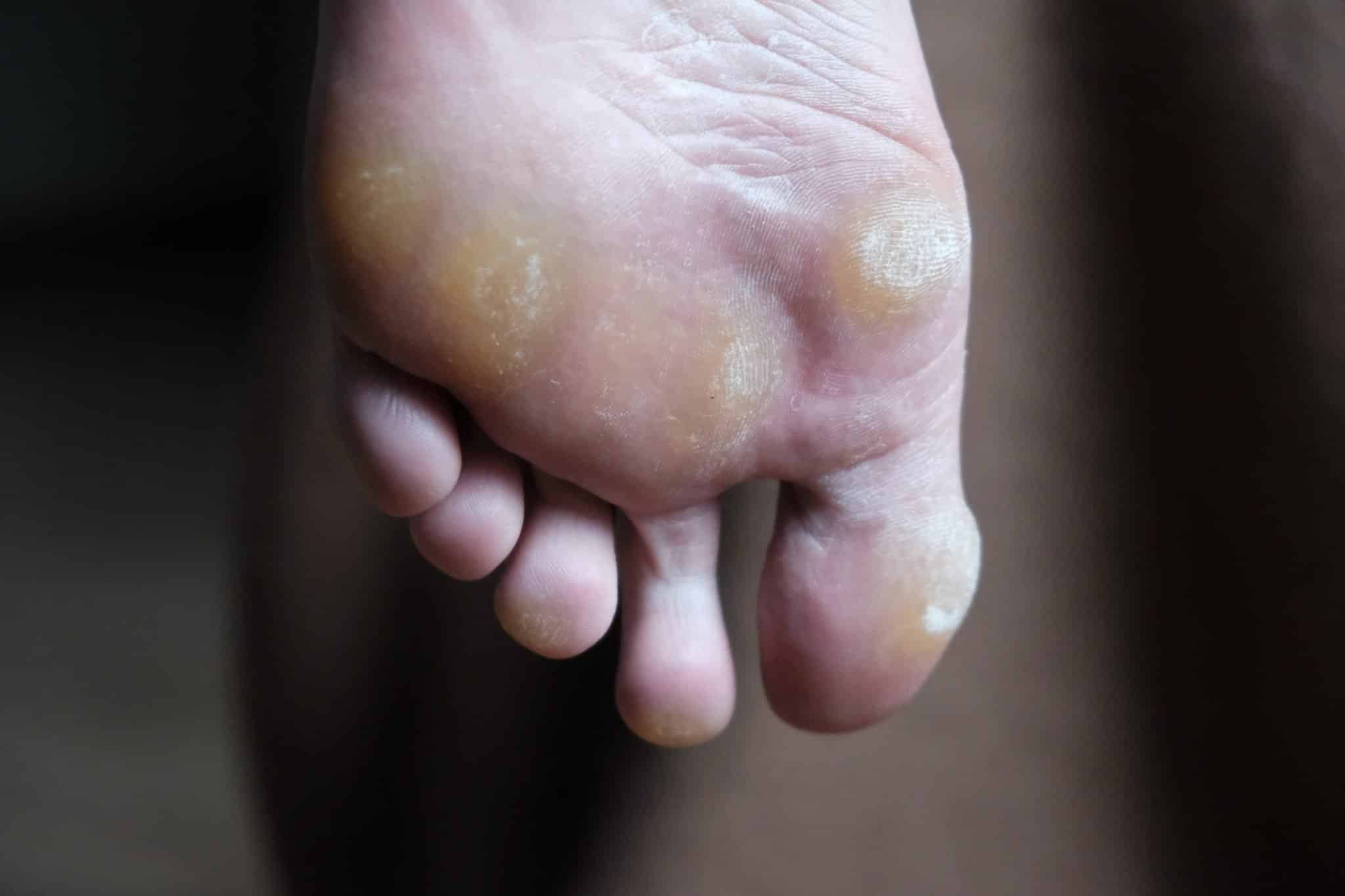 Calluses On Foot