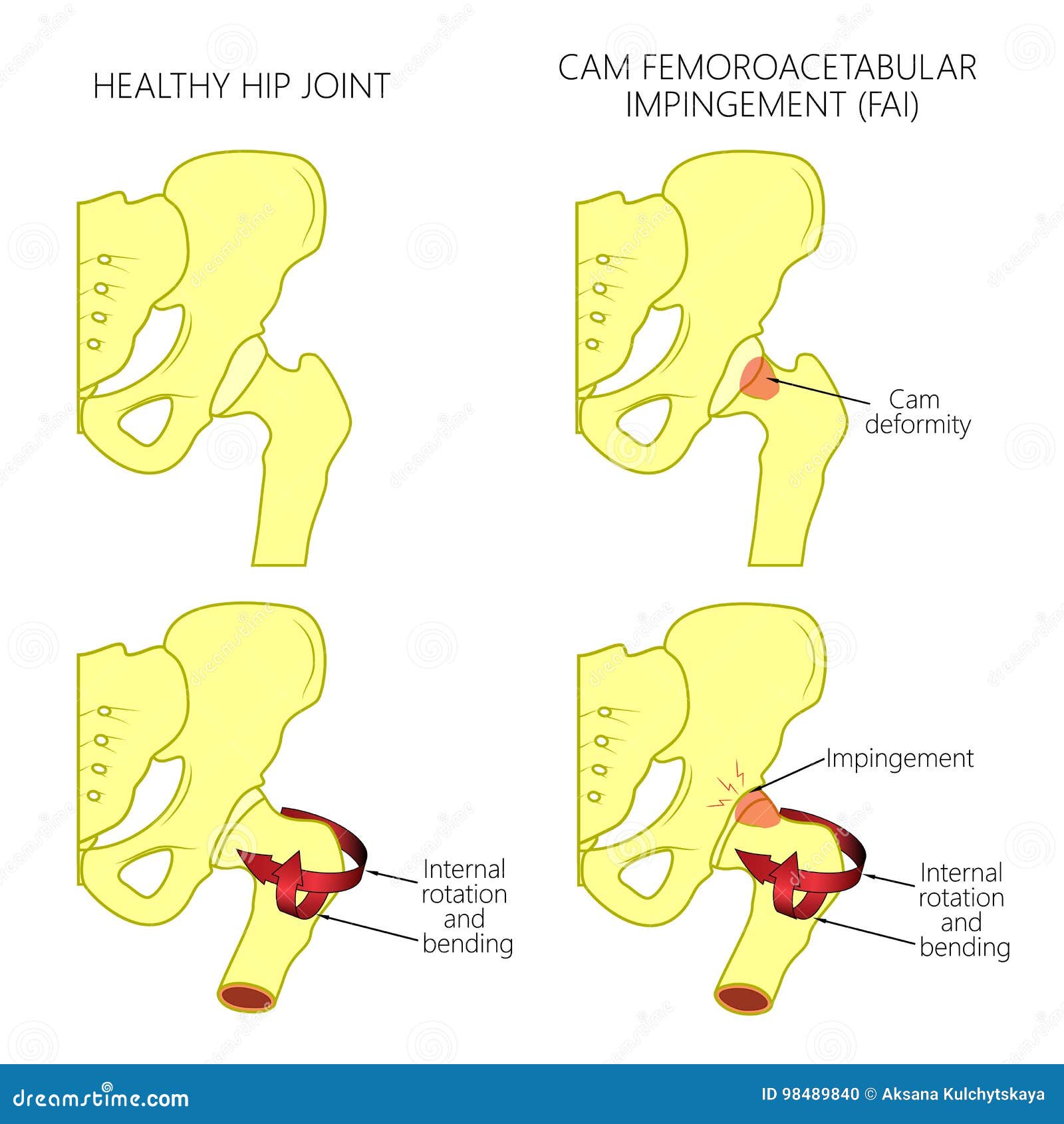 Cam Impingement Hip