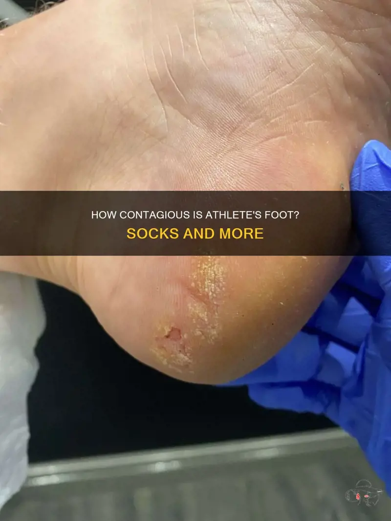 Can Athlete's Foot Spread