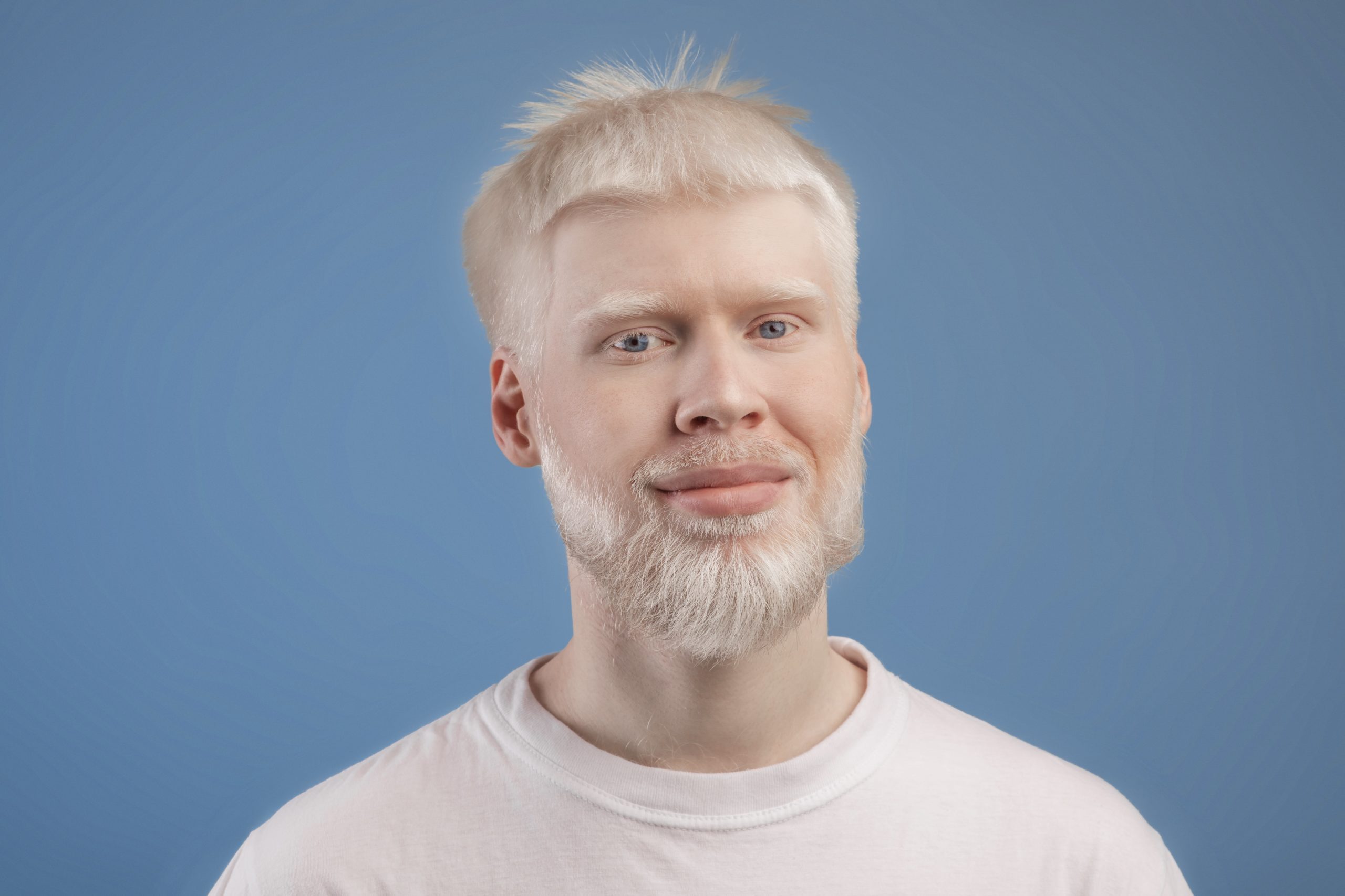Can Caucasians Be Albino