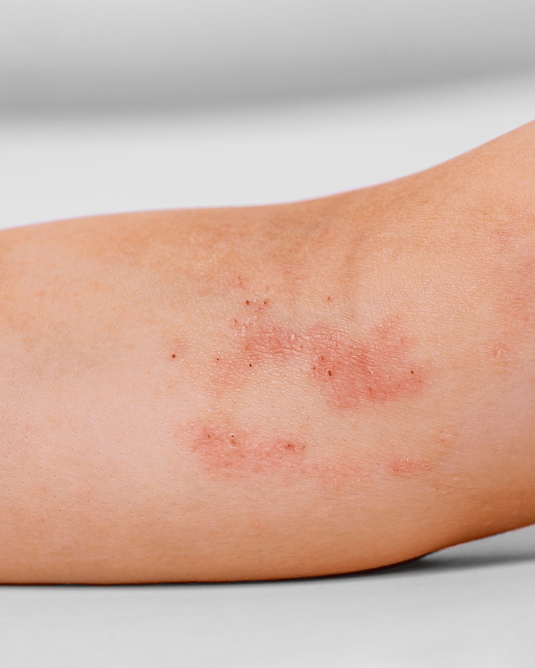 Can Eczema Spread