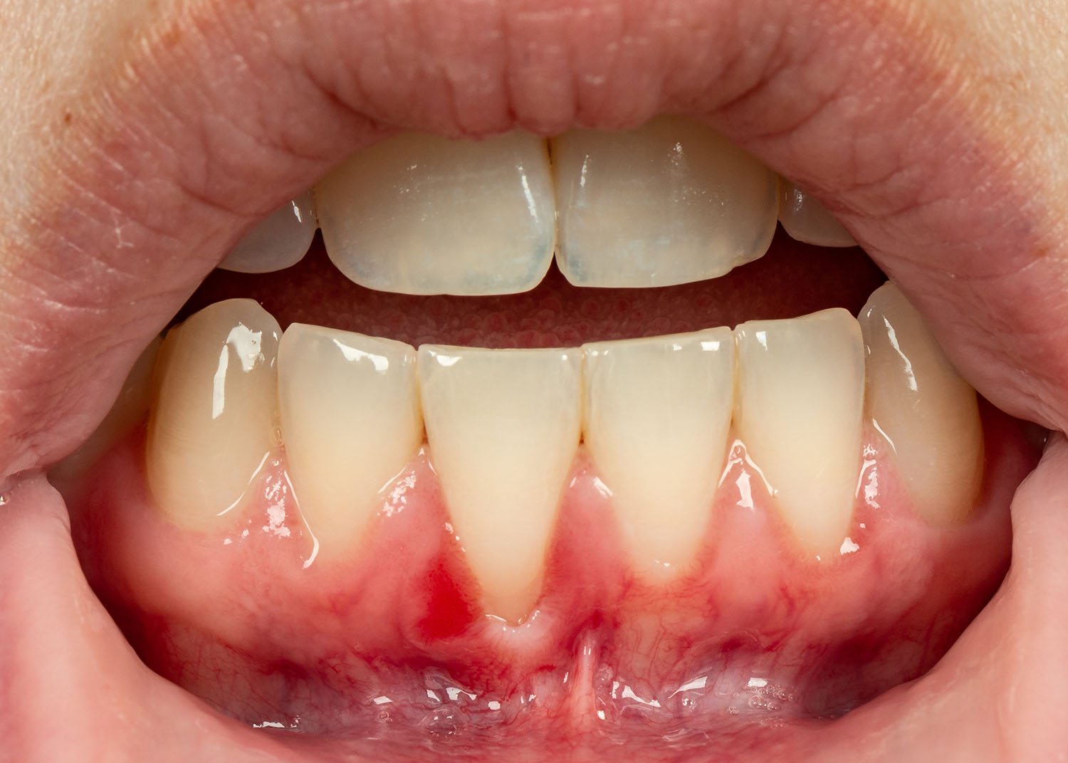 Can Gum Recession Be Reversed