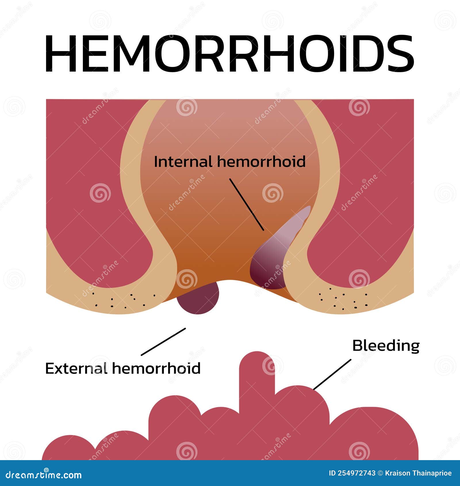 Can Hemorrhoids Bleed