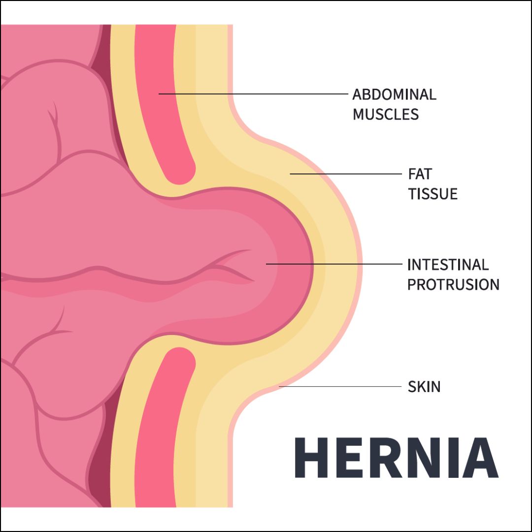 Can Hernias Make You Constipated