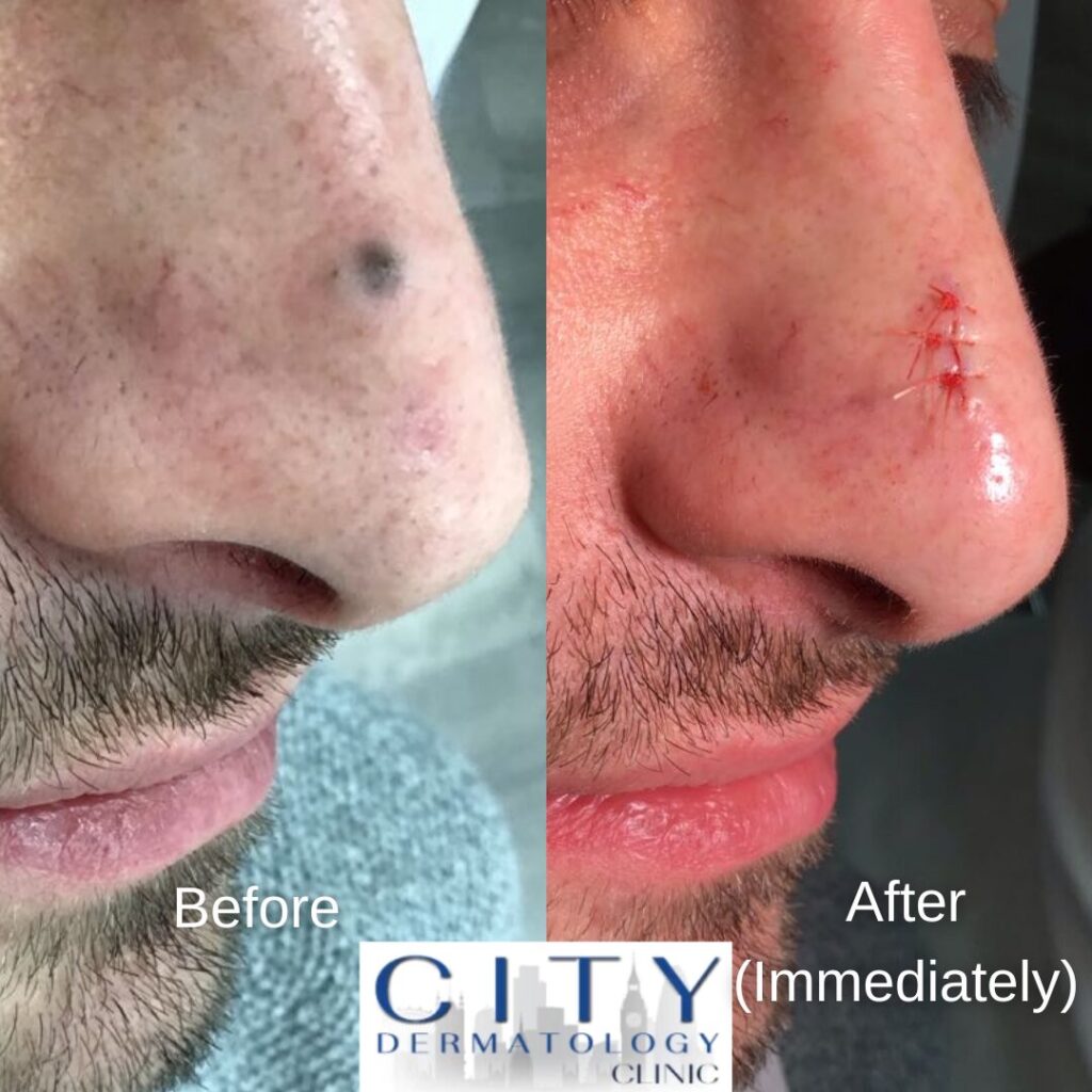 Can Moles Be Removed