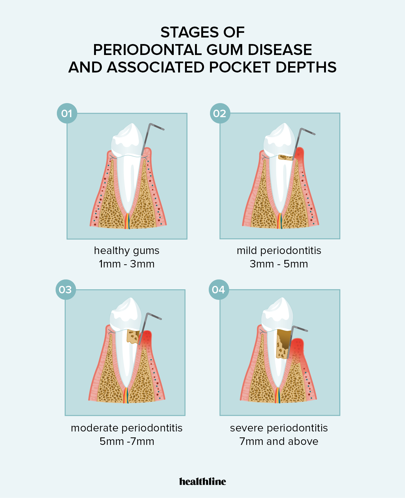 Can You Reverse Periodontal Disease