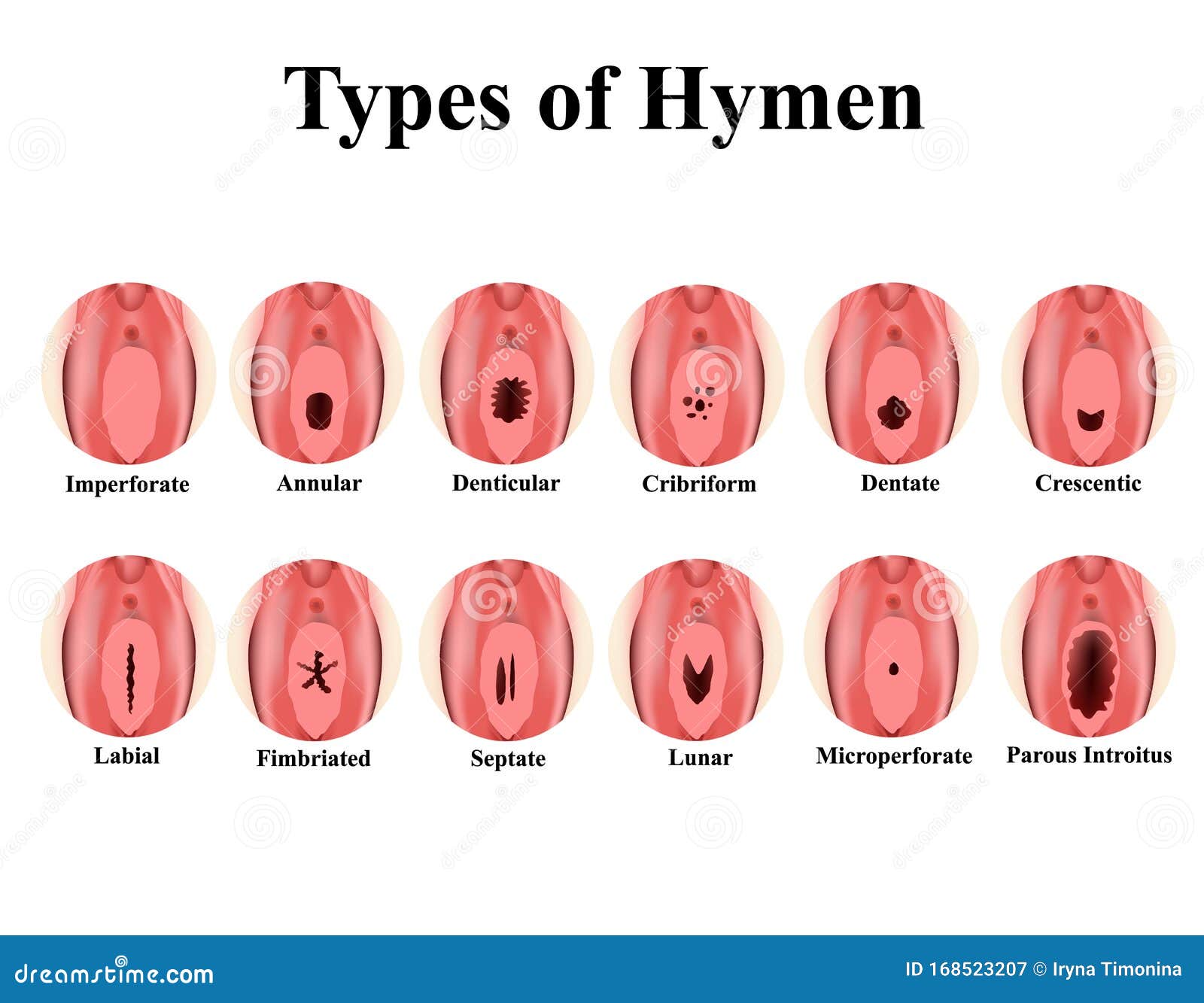 Can Your Hymen Grow Back
