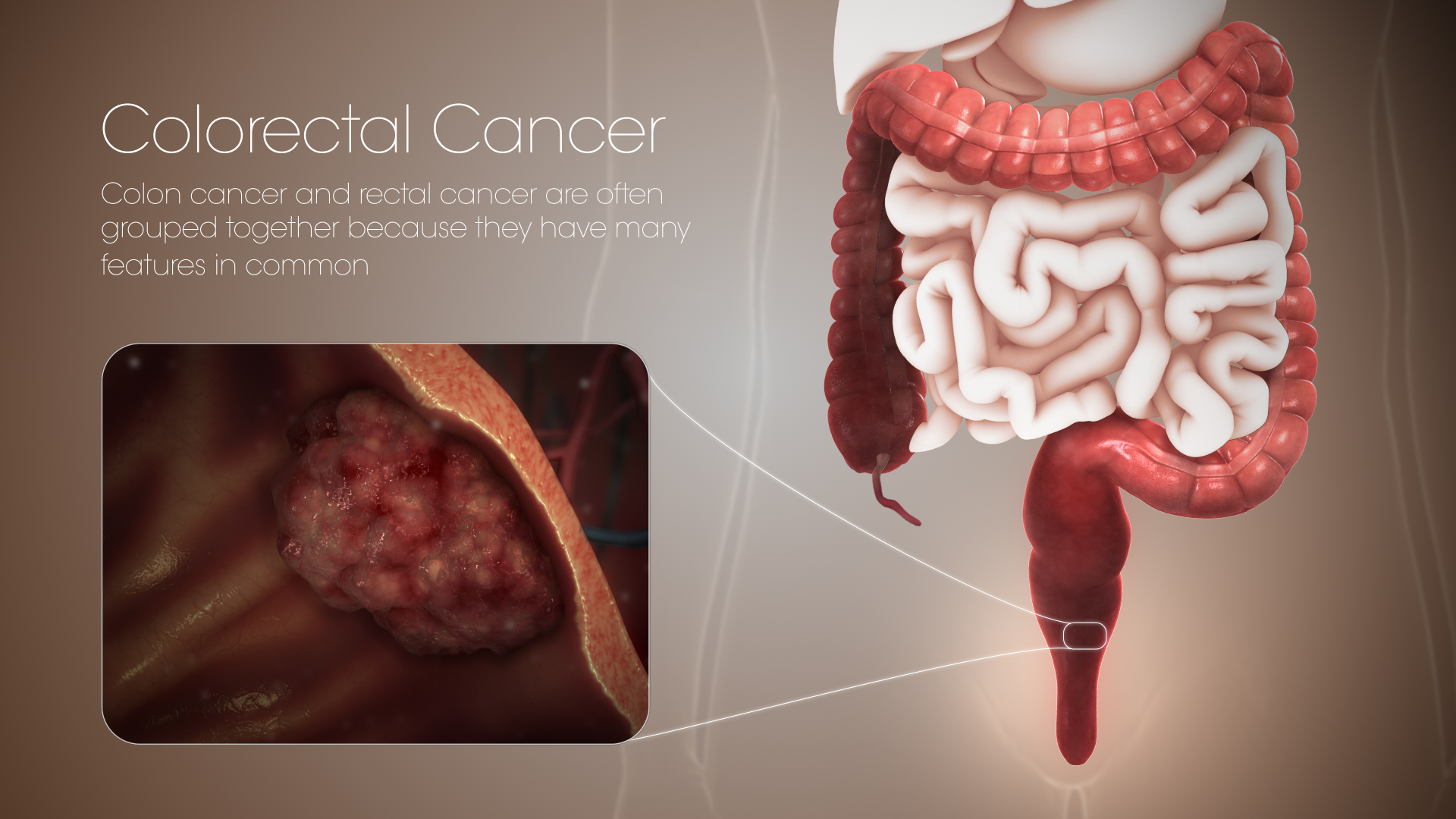 Cancer Du Colon Image