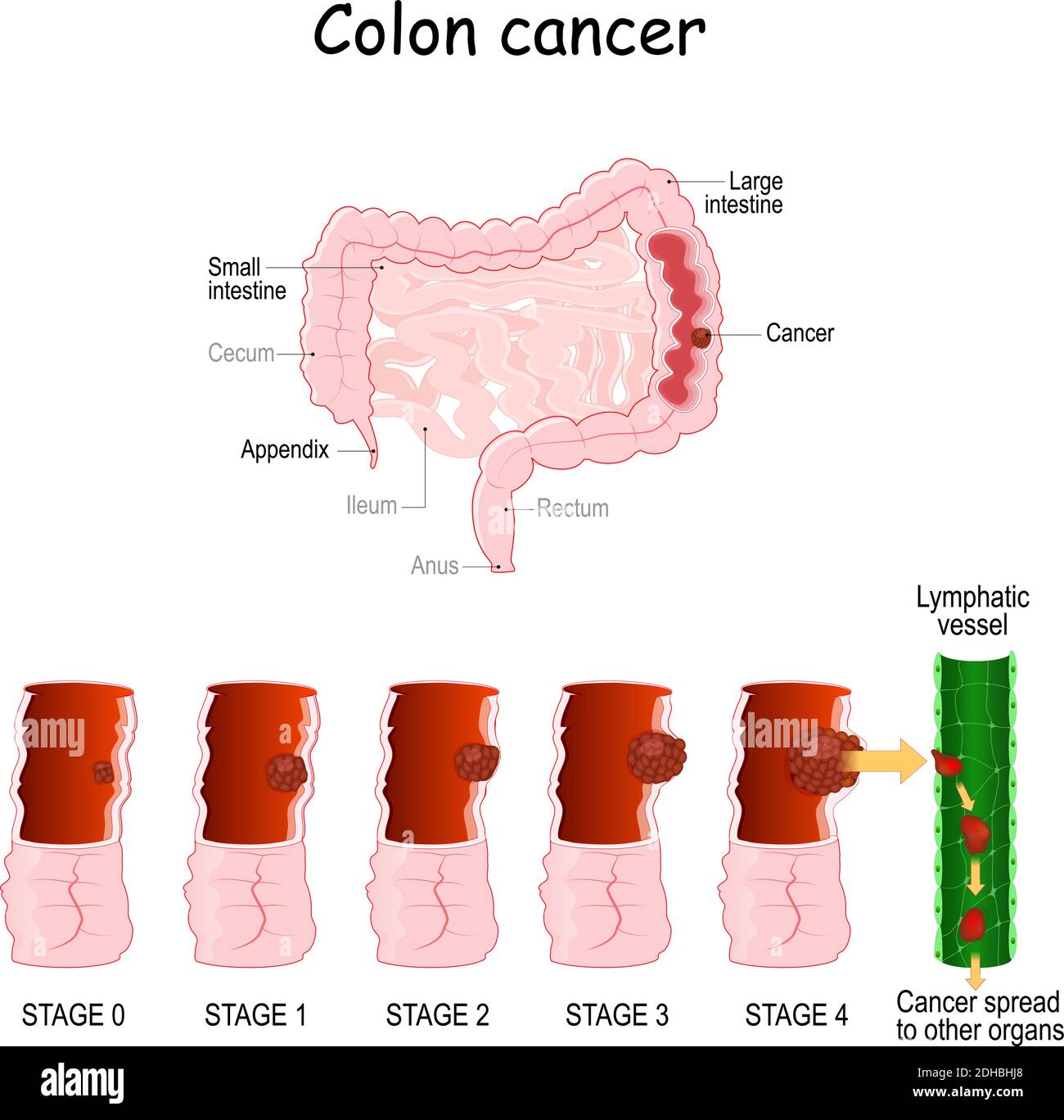 Cancer Rectal Stages