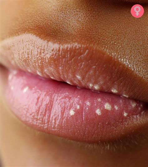 Cancer White Spots On Lips