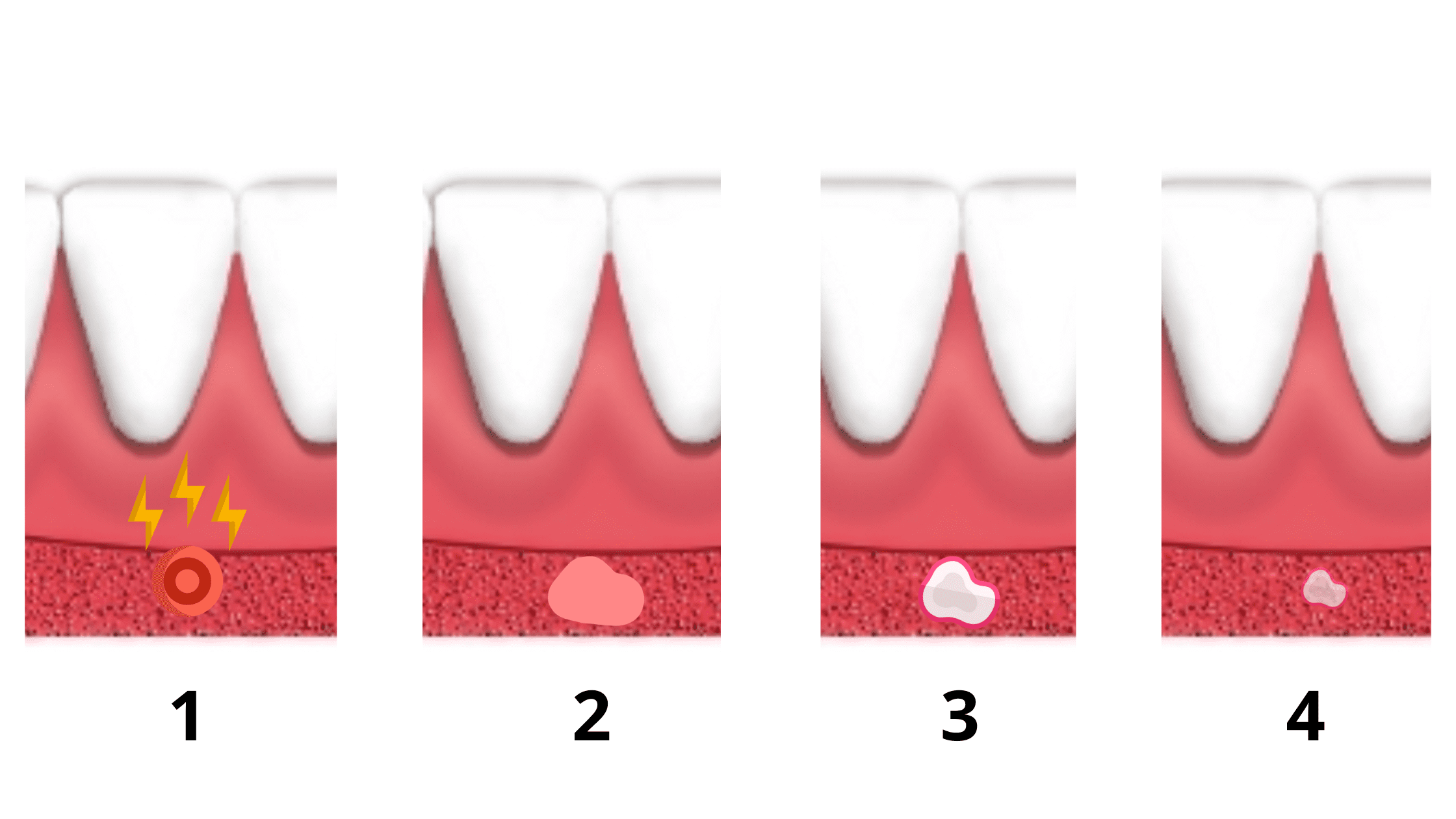 Canker Sore Healing Stages