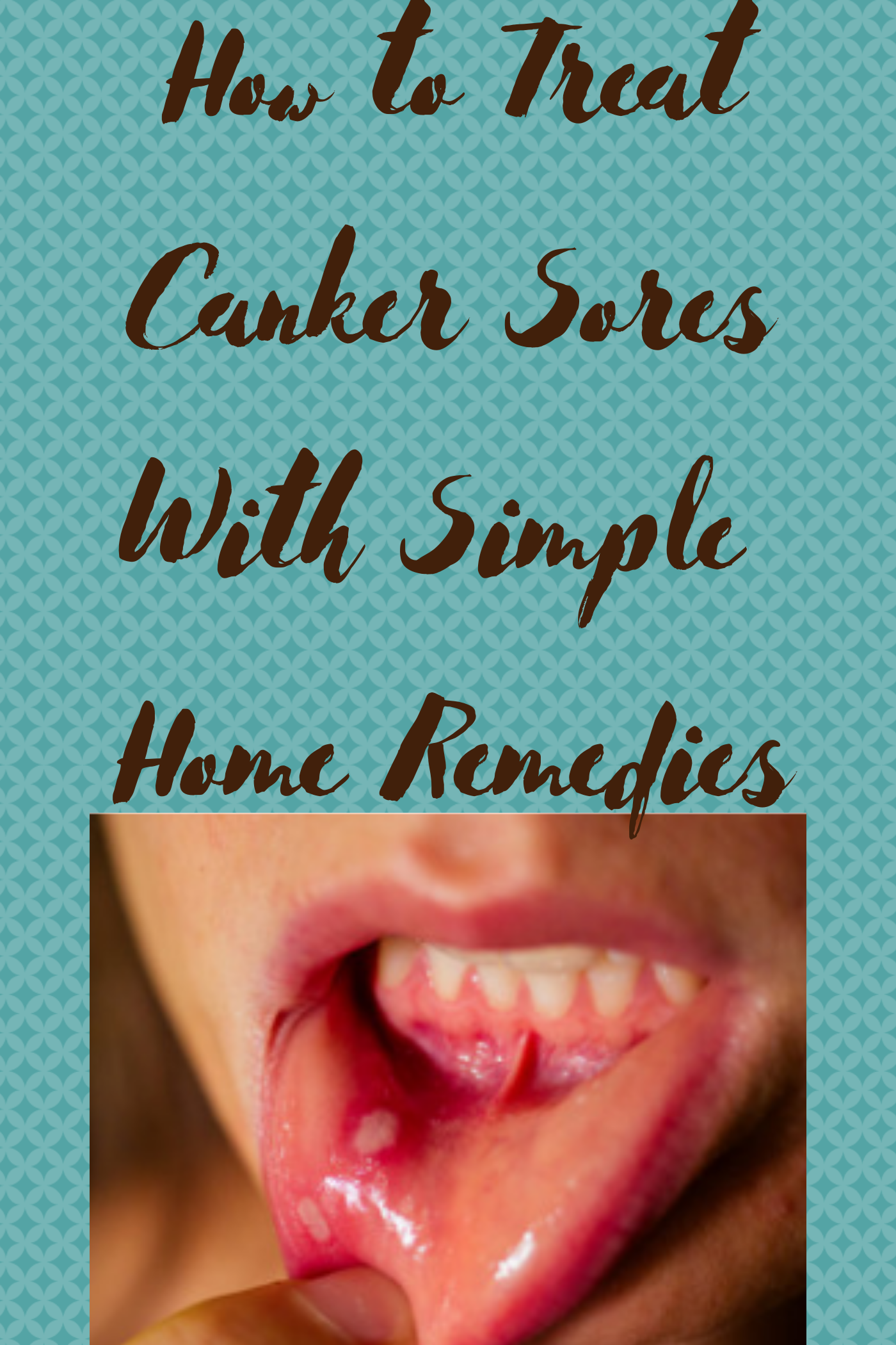 Canker Sore Treatment At Home